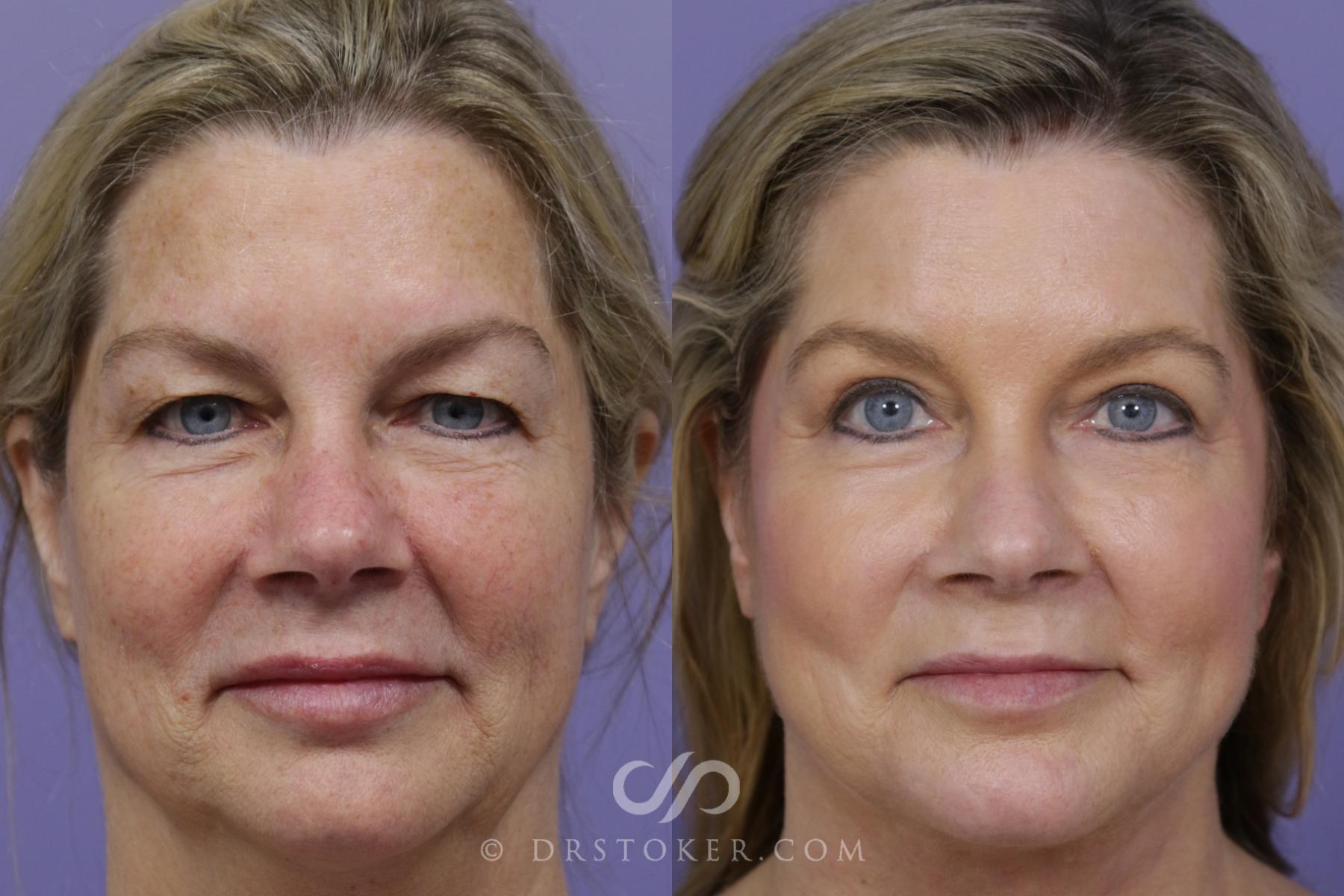 Before & After Laser Skin Resurfacing Case 1451 View #1 View in Los Angeles, CA