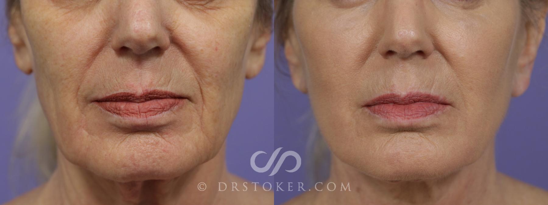 Before & After Laser Skin Resurfacing Case 1453 View #1 View in Los Angeles, CA