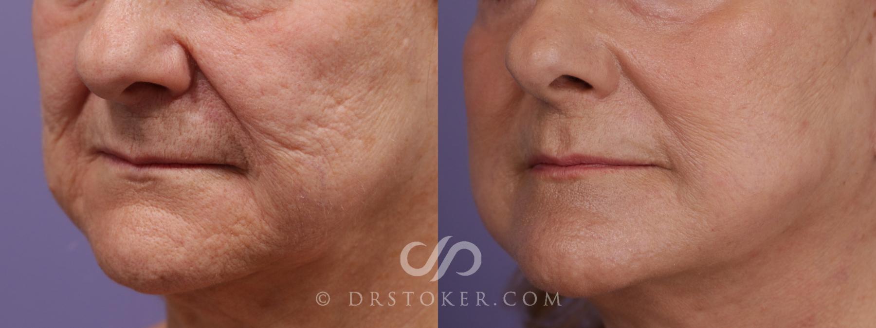 Before & After Laser Skin Resurfacing (Mouth) Case 1638 View #1 View in Los Angeles, CA