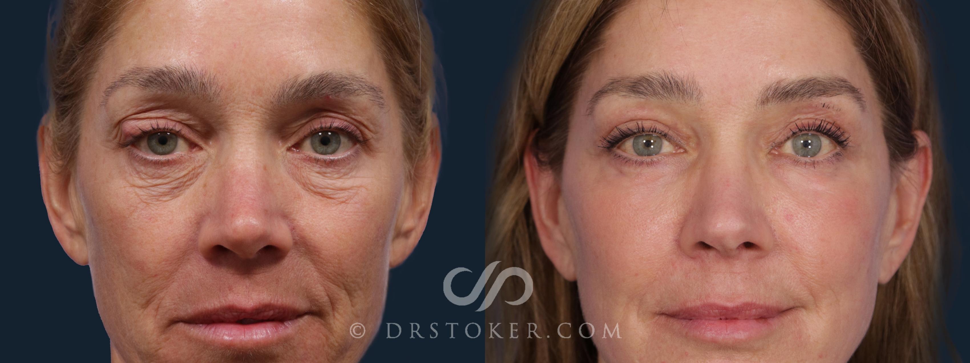 Before & After Laser Skin Resurfacing Case 1811 Front View in Los Angeles, CA