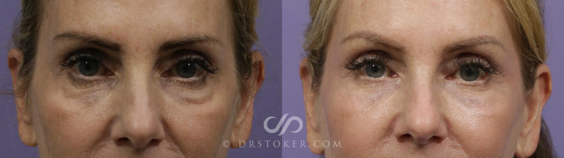 Before & After Laser Skin Resurfacing Case 2278 Front View in Los Angeles, CA