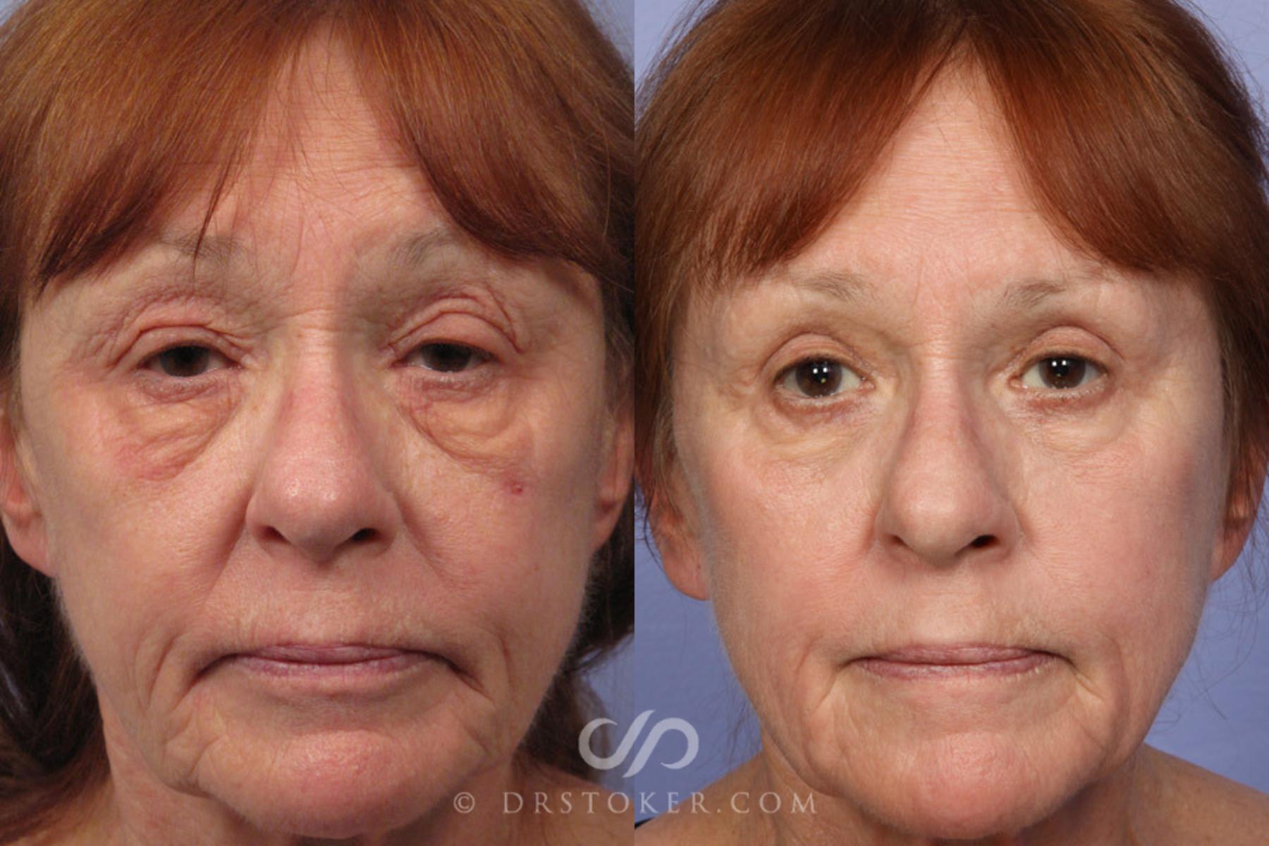 Before & After Laser Skin Resurfacing Case 297 View #1 View in Los Angeles, CA