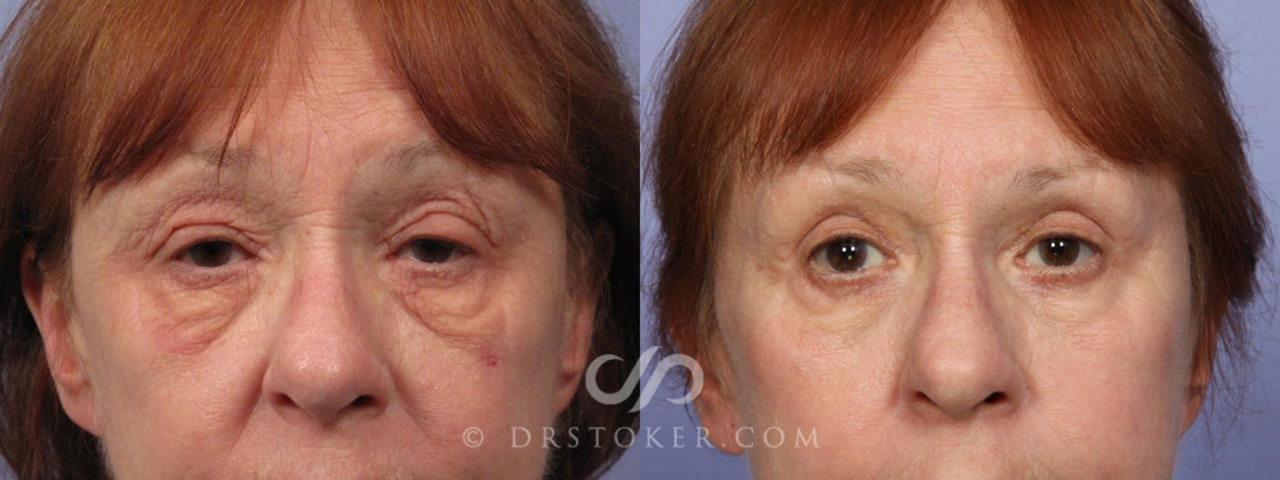 Before & After Eyelid Surgery Case 297 View #2 View in Los Angeles, CA