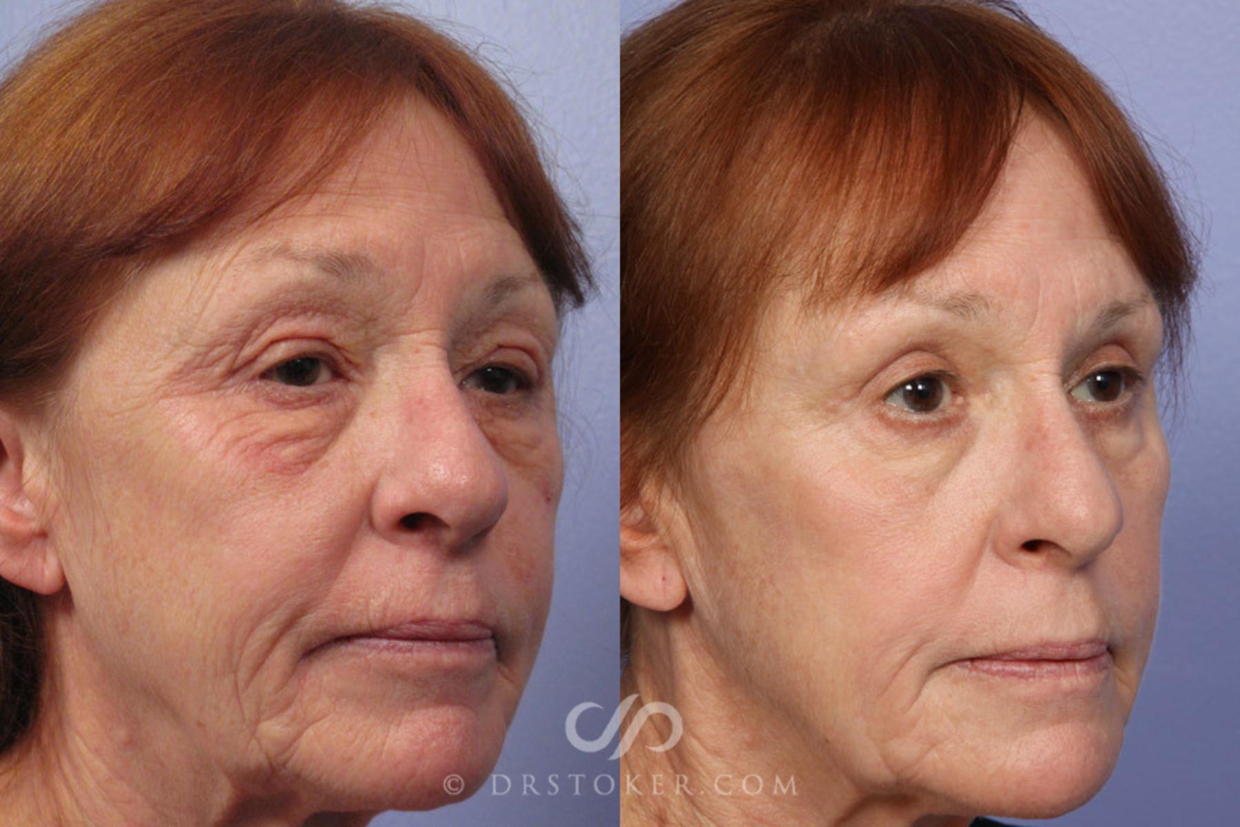 Before & After Eyelid Surgery Case 297 View #3 View in Los Angeles, CA