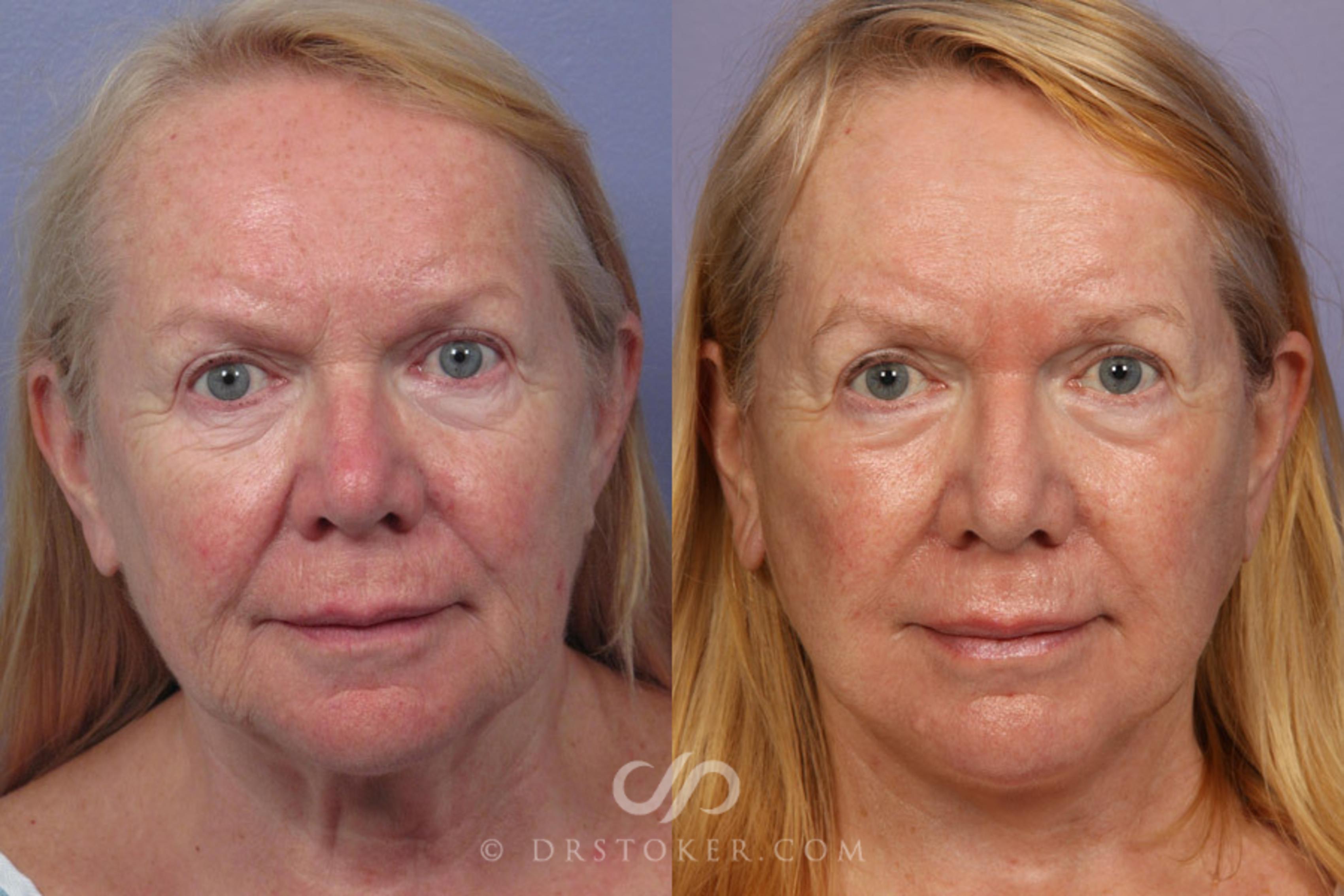 Before & After Laser Skin Resurfacing Case 322 View #1 View in Los Angeles, CA