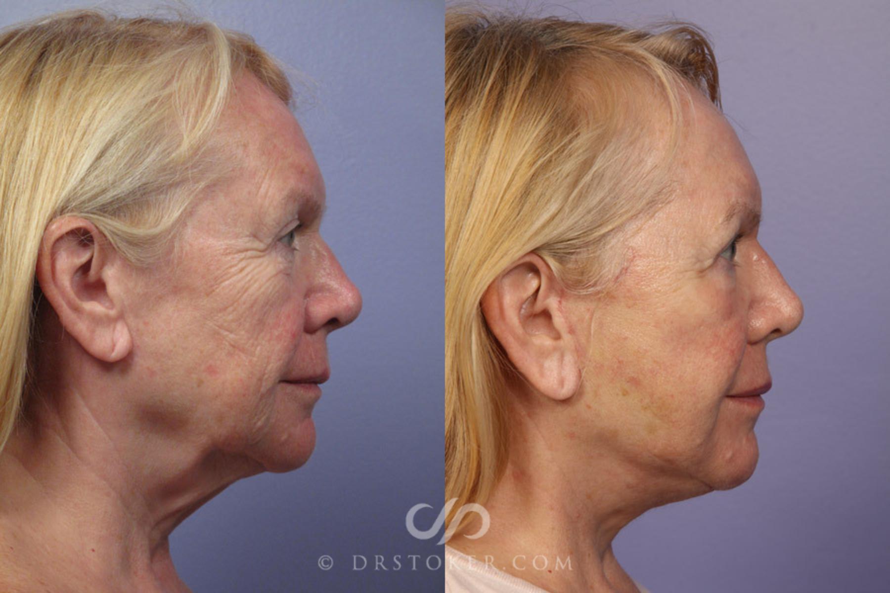 Before & After Facelift - Traceless Facelift Case 322 View #3 View in Los Angeles, CA