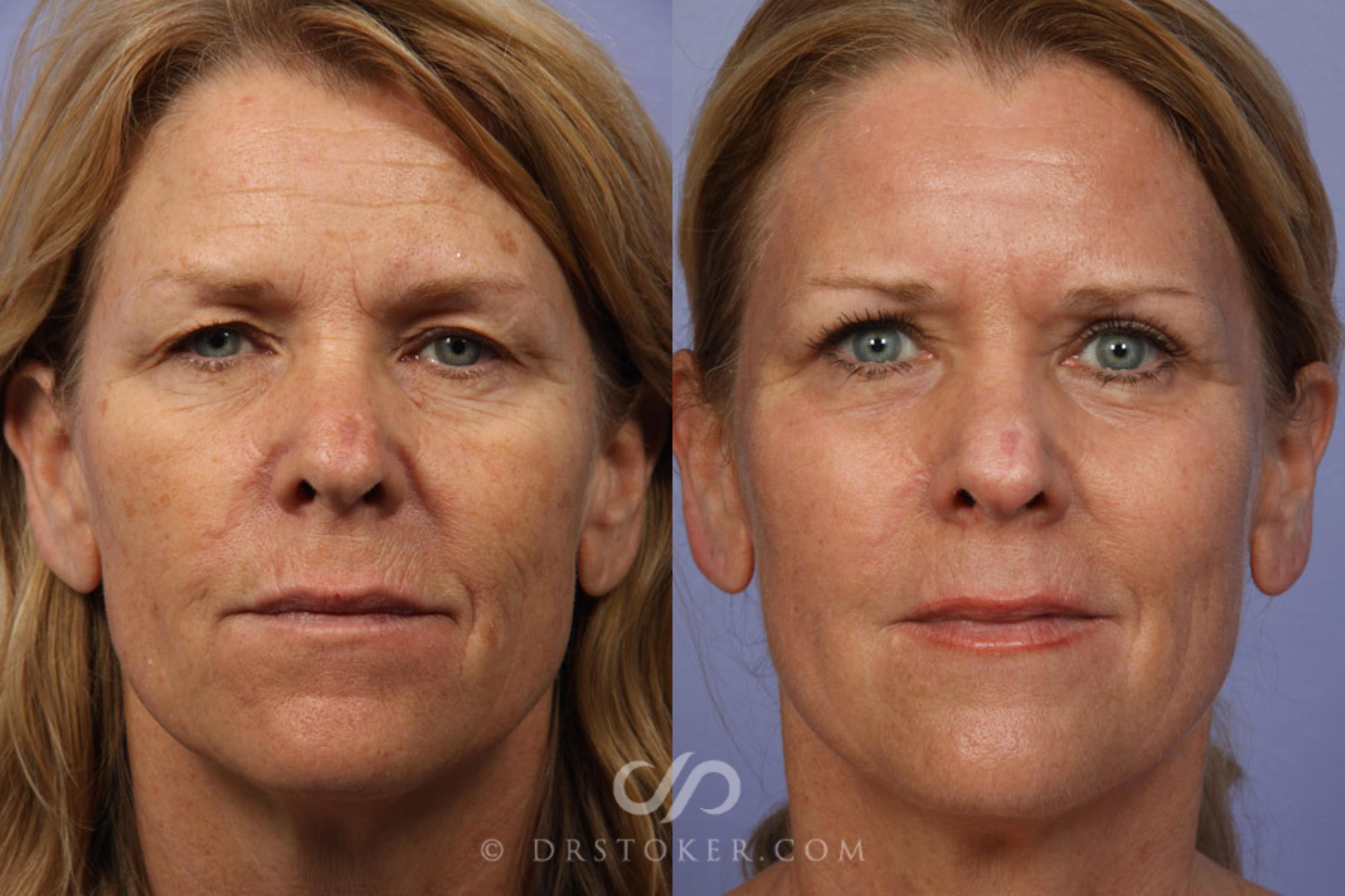 Before & After Laser Resurfacing  Case 332 View #1 View in Marina del Rey, CA