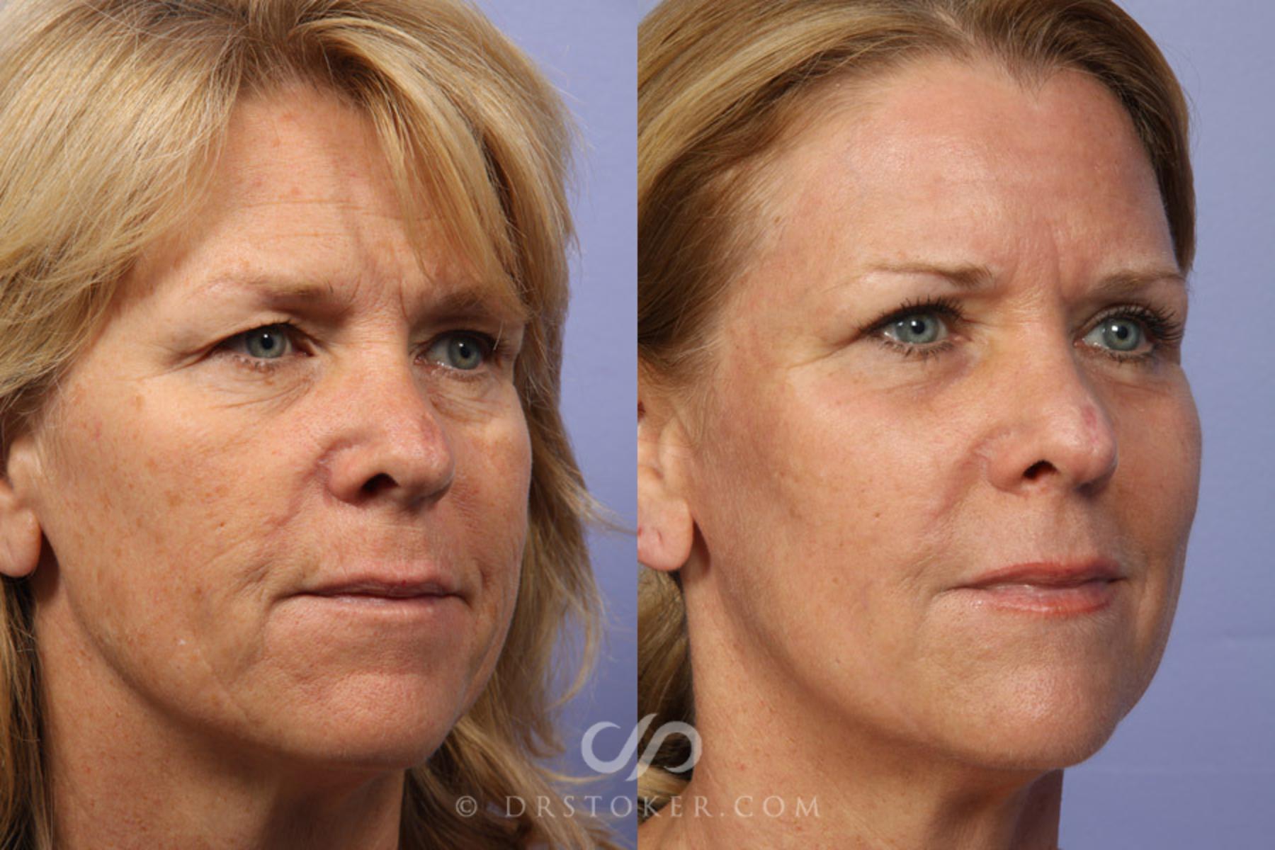 Before & After Laser Skin Resurfacing Case 332 View #2 View in Los Angeles, CA