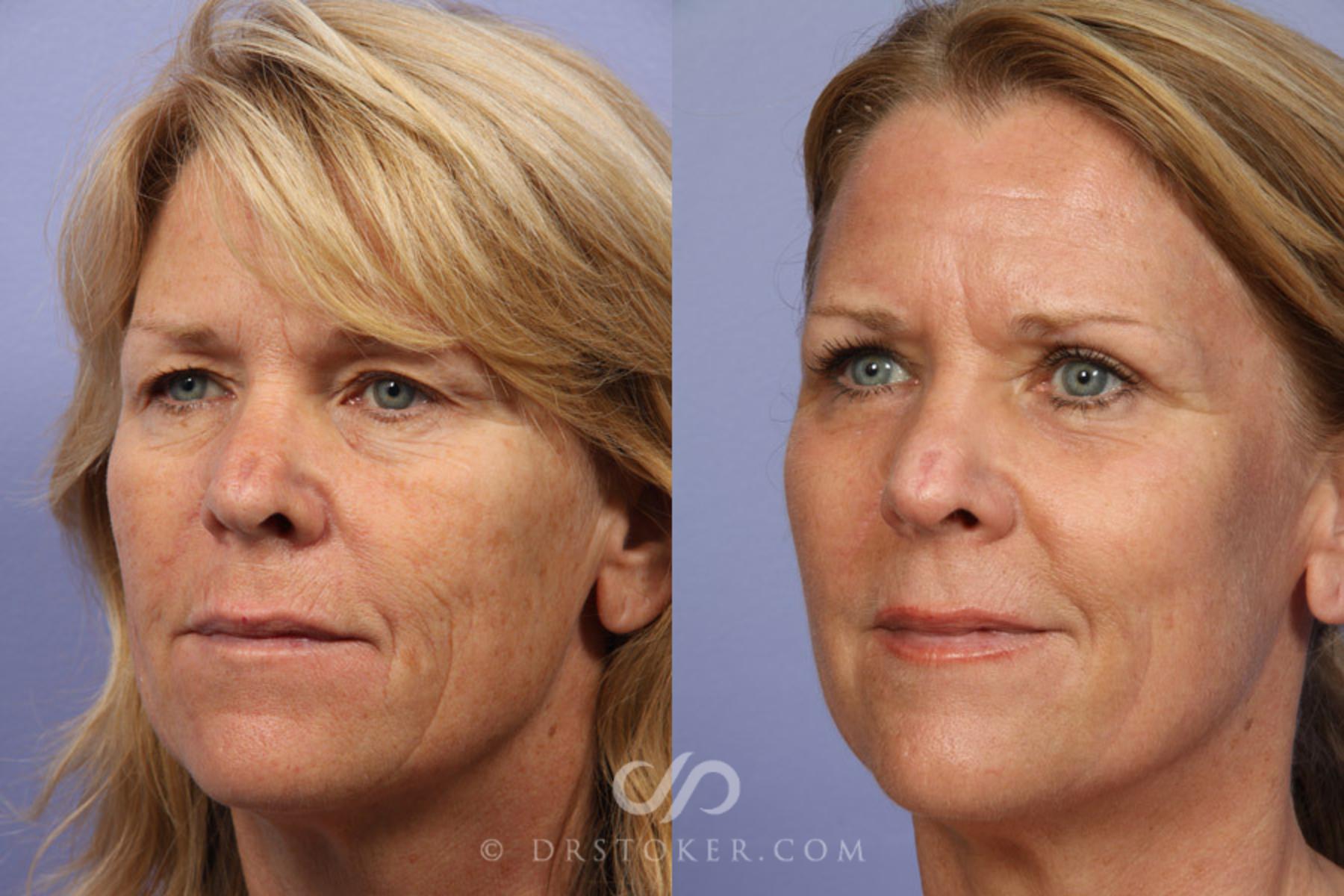 Before & After Laser Skin Resurfacing Case 332 View #3 View in Los Angeles, CA