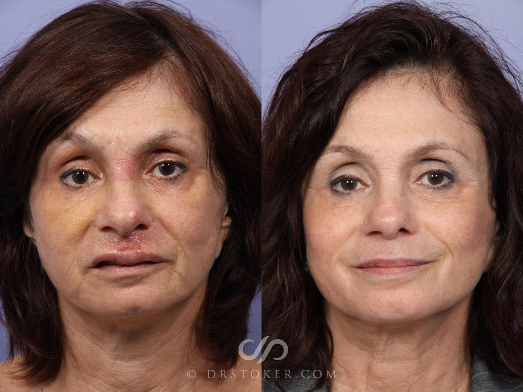 Before & After Rhinoplasty Case 415 View #1 View in Los Angeles, CA