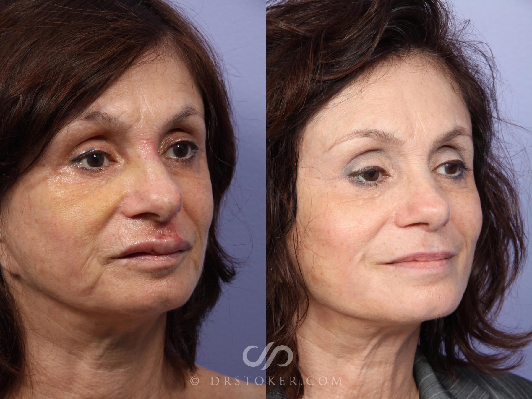 Before & After Rhinoplasty Case 415 View #2 View in Los Angeles, CA