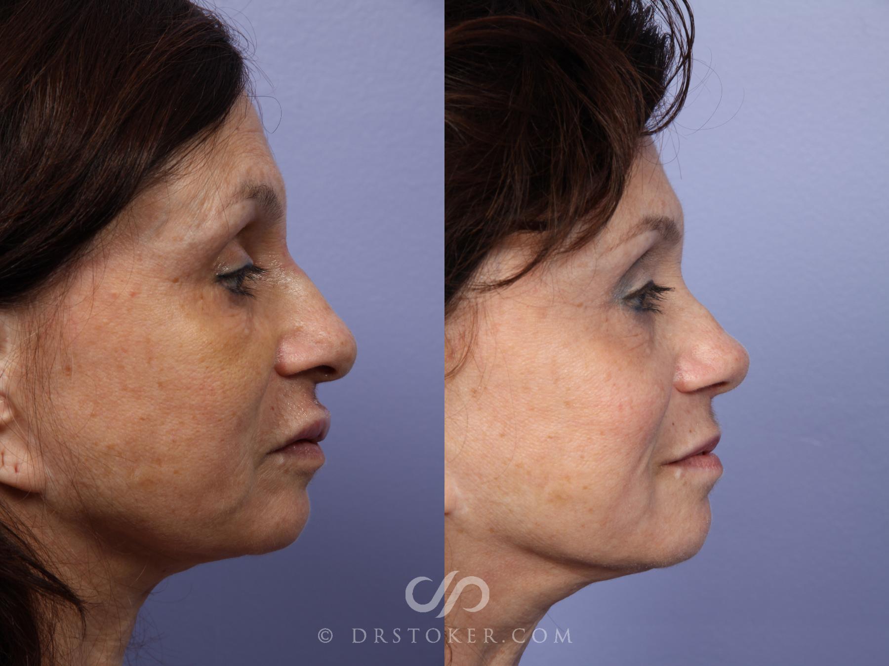 Before & After Rhinoplasty Case 415 View #3 View in Los Angeles, CA