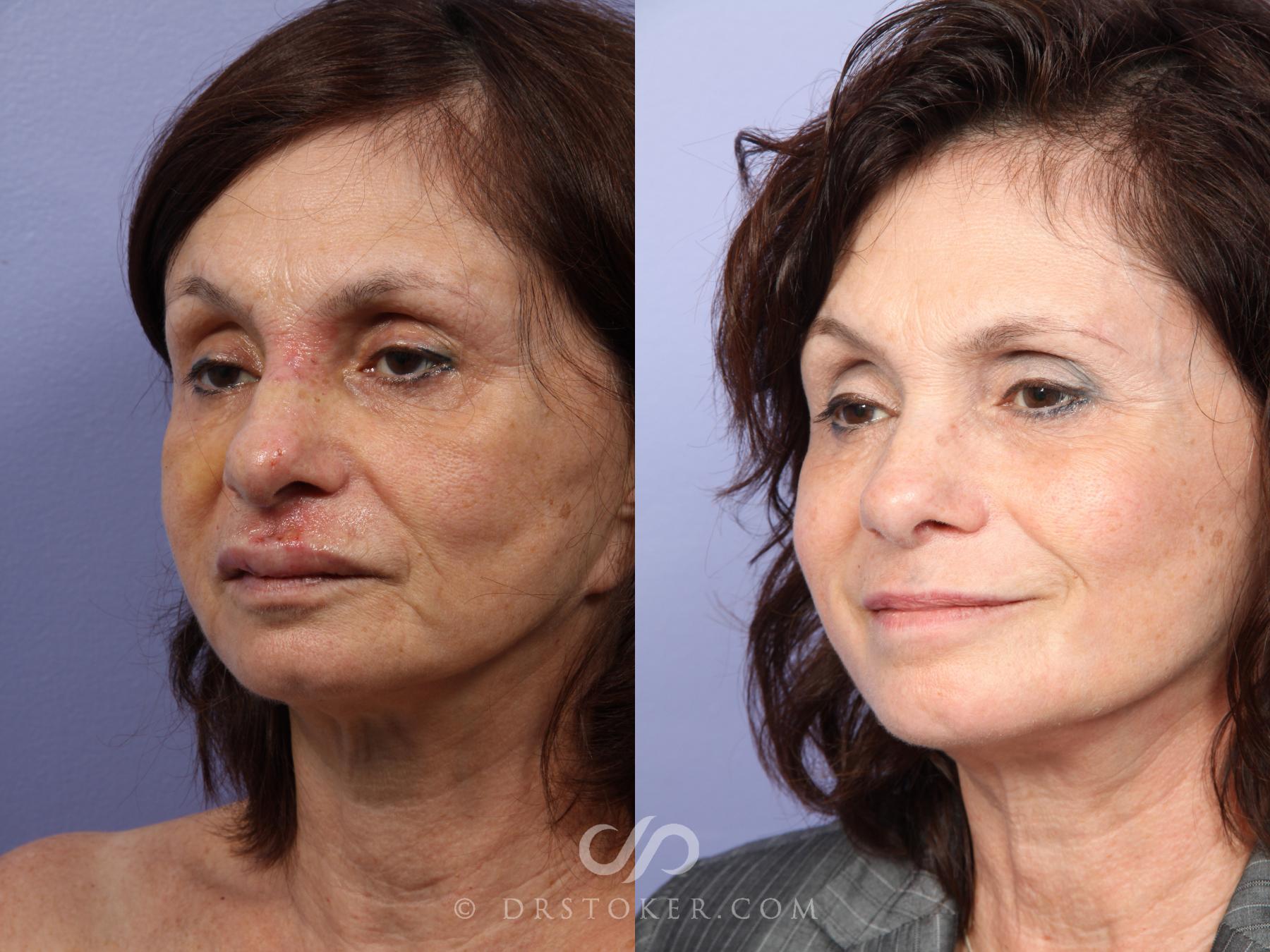 Before & After Laser Skin Resurfacing Case 415 View #4 View in Los Angeles, CA