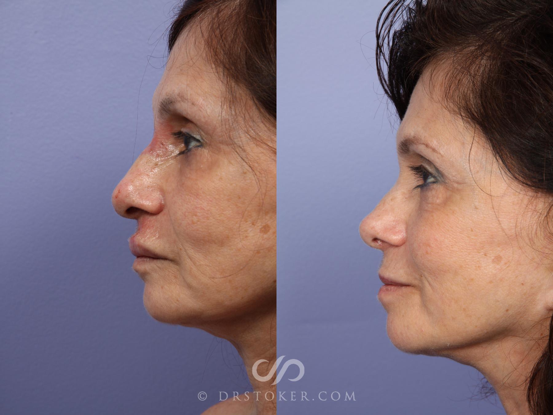 Before & After Rhinoplasty Case 415 View #5 View in Los Angeles, CA
