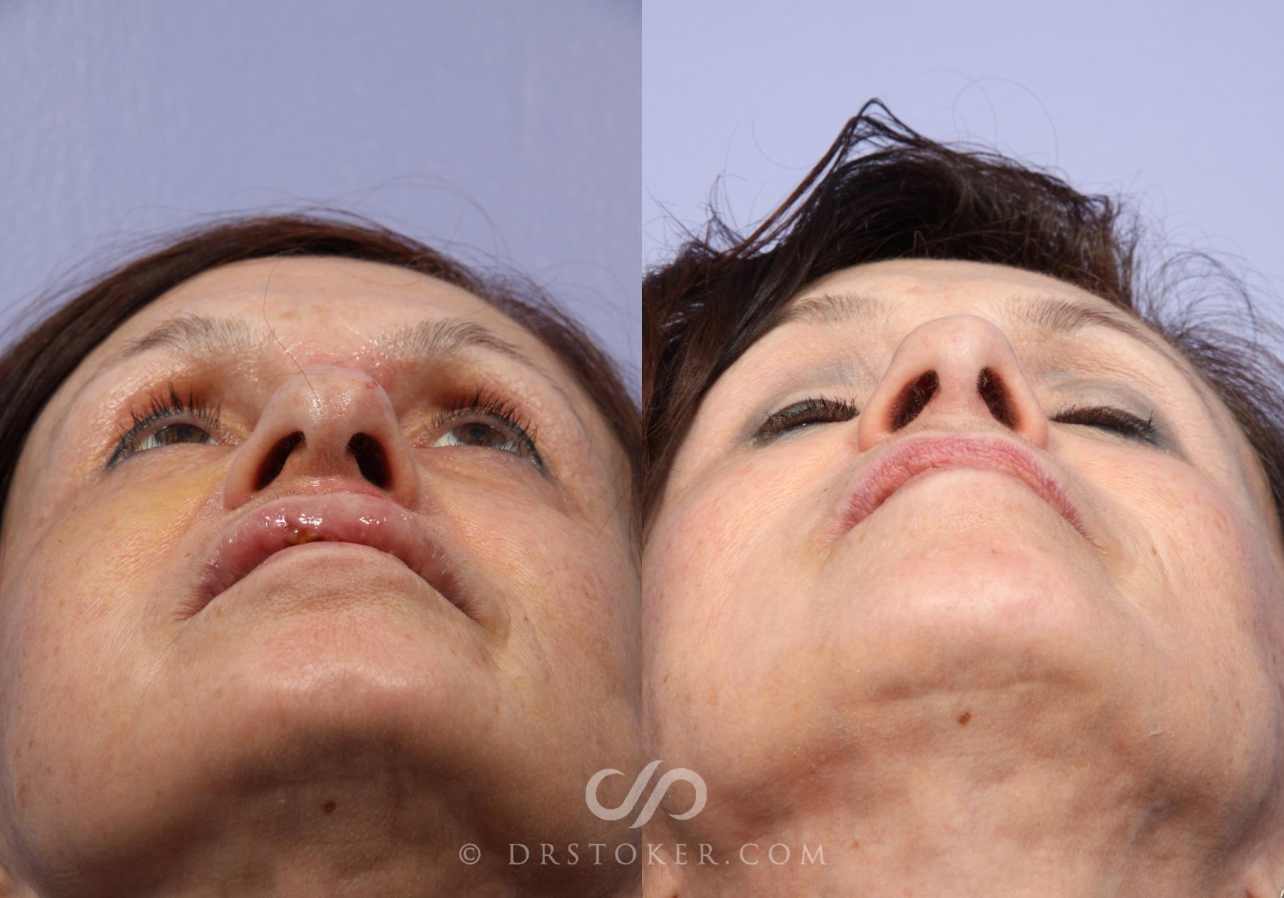 Before & After Rhinoplasty Case 415 View #6 View in Los Angeles, CA