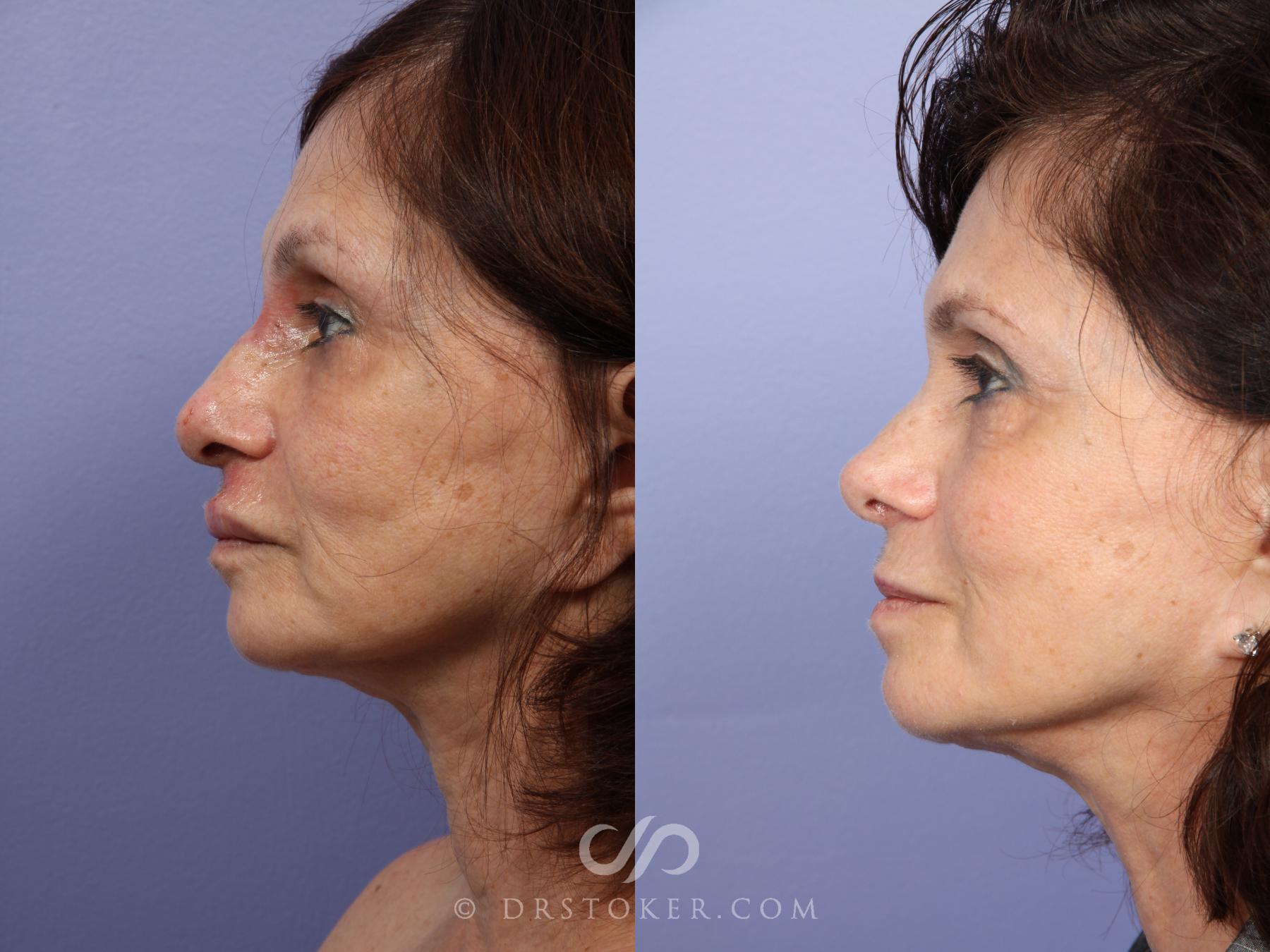 Before & After Laser Skin Resurfacing Case 415 View #7 View in Los Angeles, CA