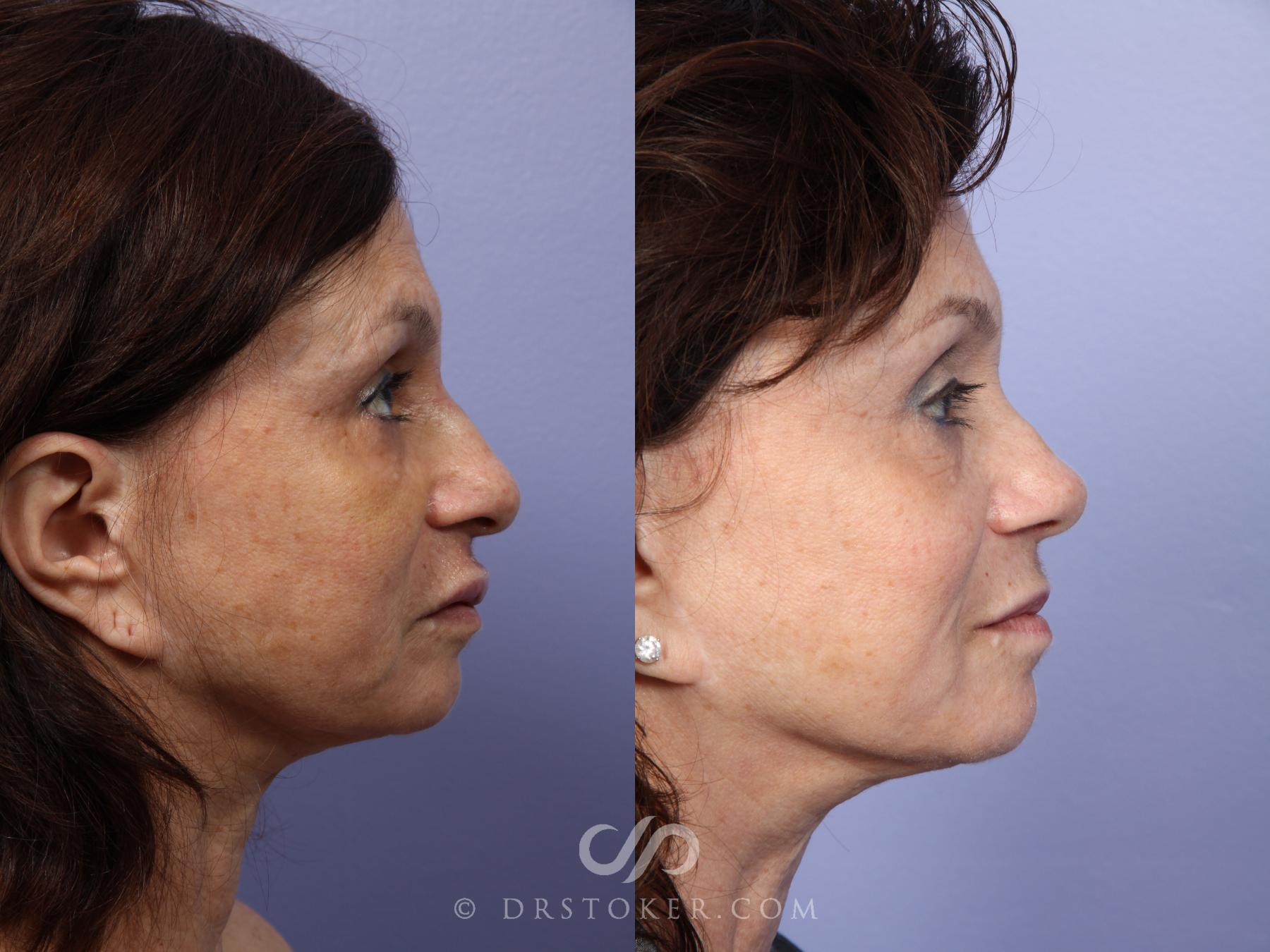 Before & After Laser Skin Resurfacing Case 415 View #8 View in Los Angeles, CA