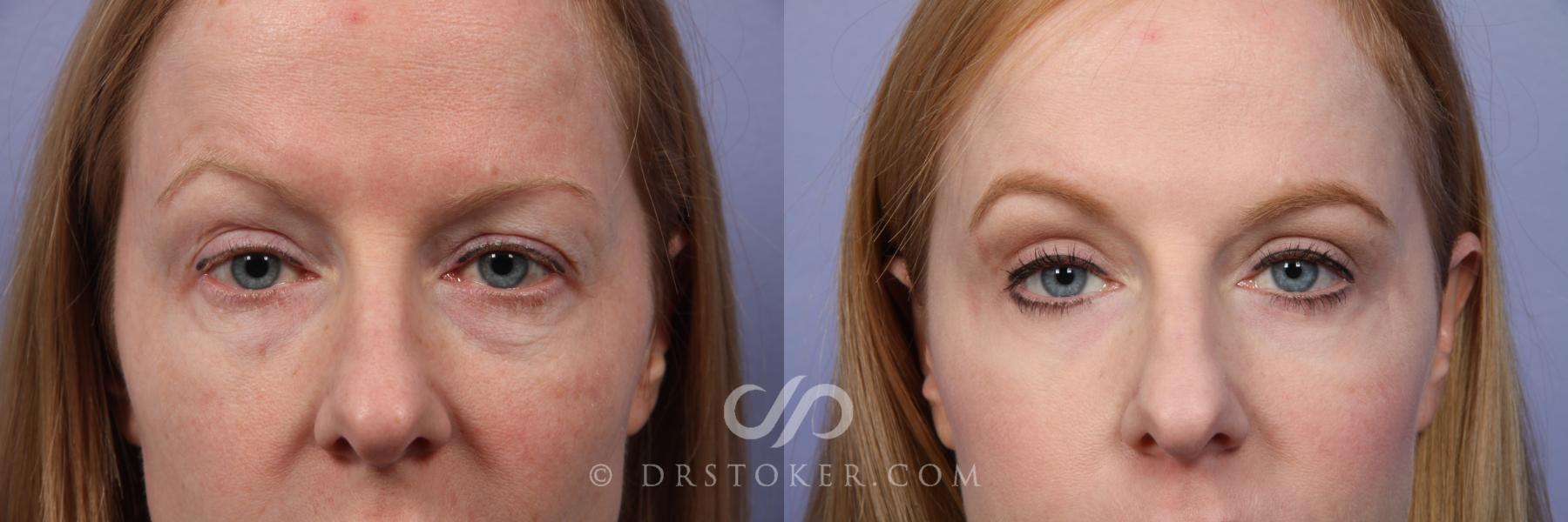 Before & After Eyelid Surgery Case 490 View #1 View in Los Angeles, CA