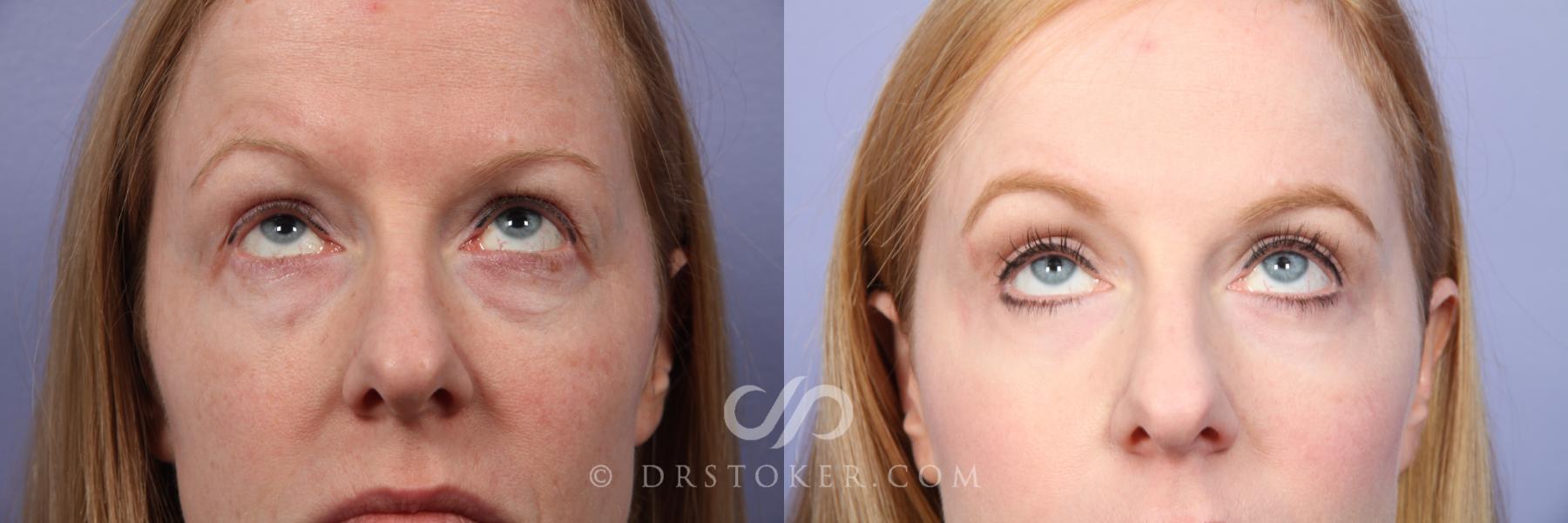 Before & After Eyelid Surgery Case 490 View #2 View in Los Angeles, CA
