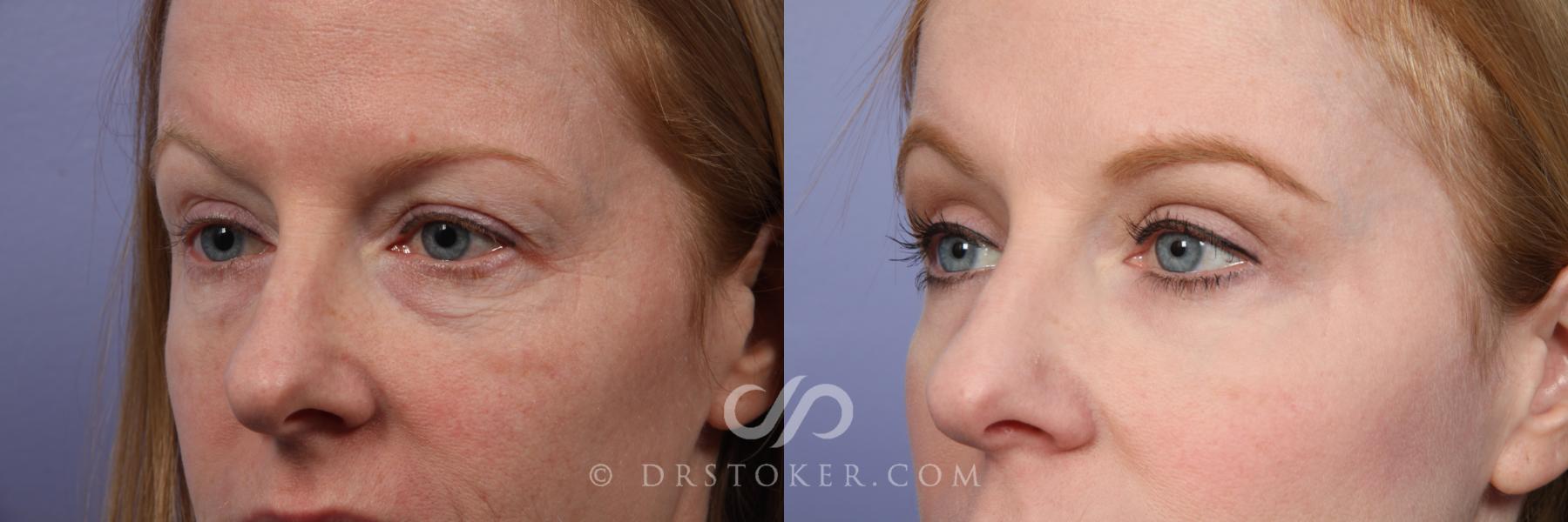 Before & After Laser Skin Resurfacing Case 490 View #3 View in Los Angeles, CA