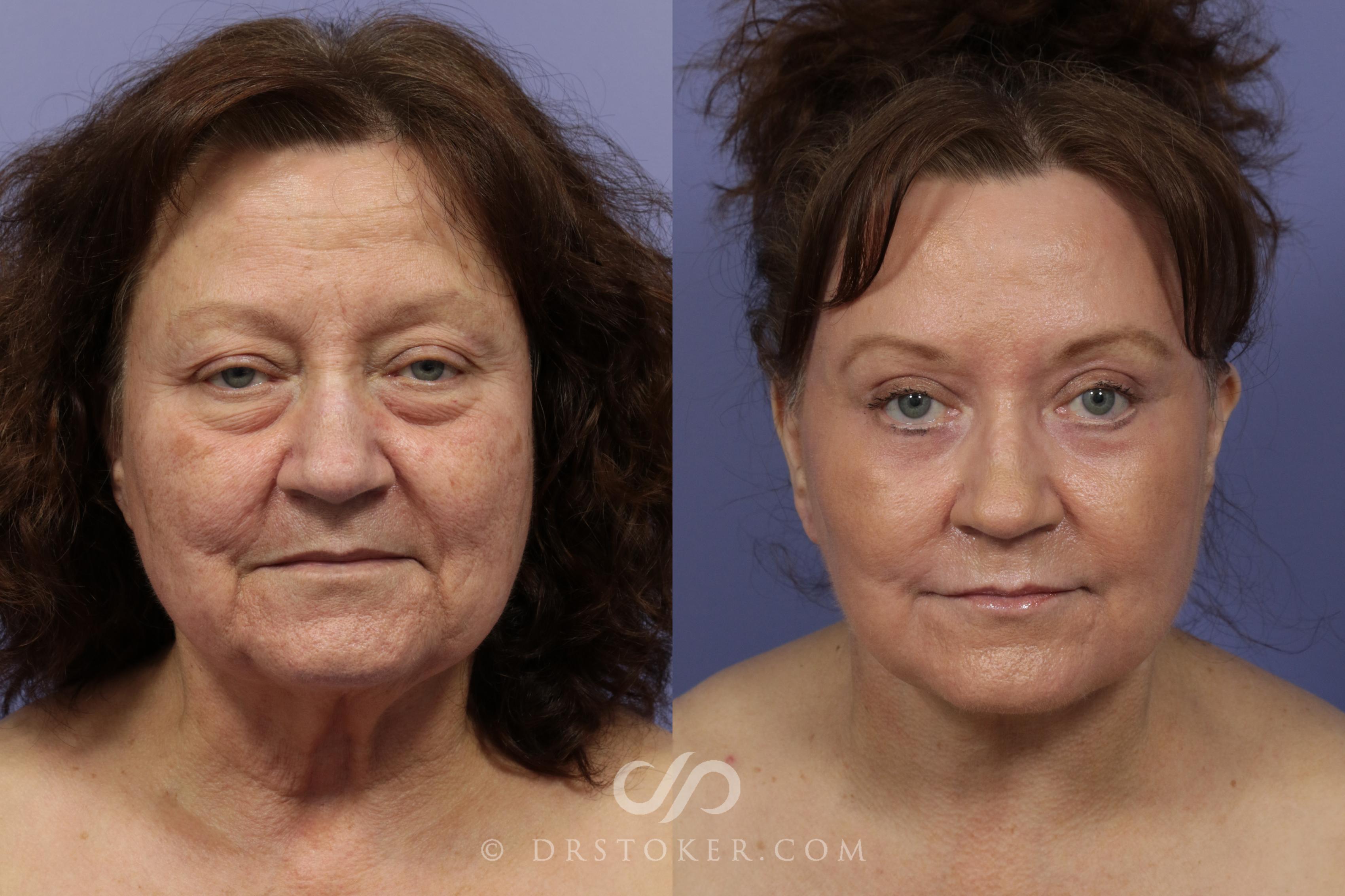 Before & After Laser Skin Resurfacing Case 893 View #1 View in Los Angeles, CA