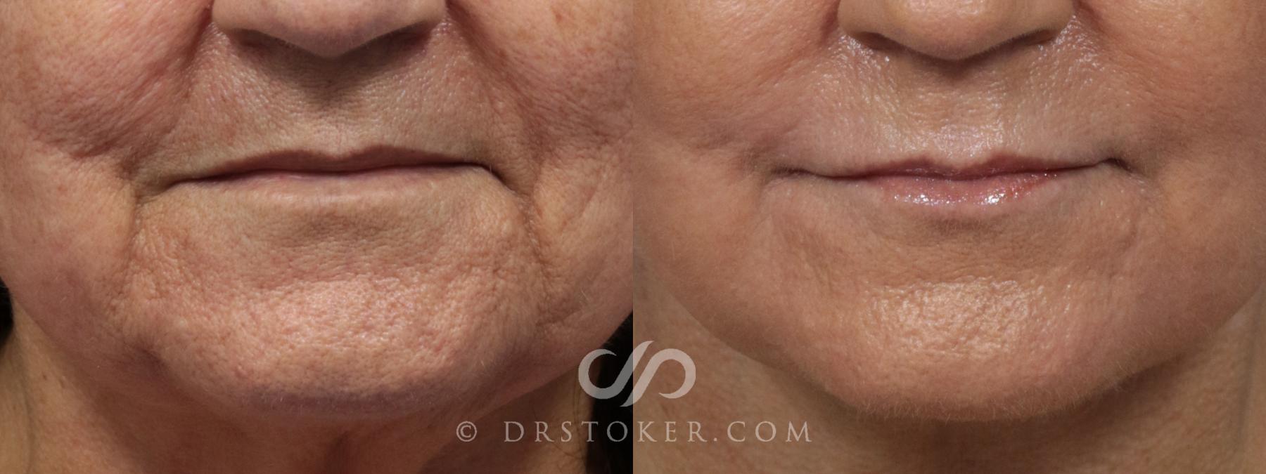 Before & After Laser Skin Resurfacing (Mouth) Case 895 View #1 View in Los Angeles, CA