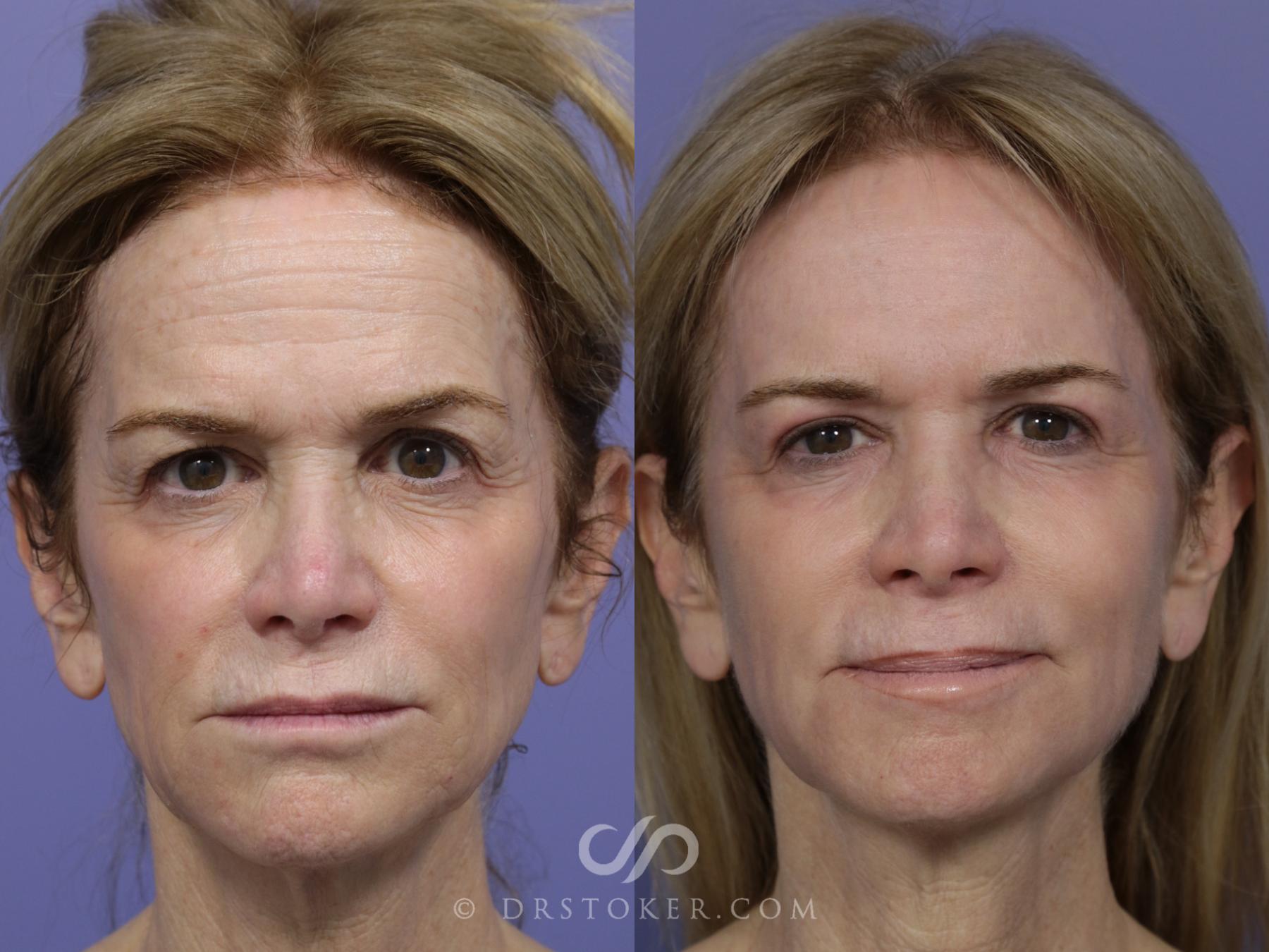 Before & After Laser Skin Resurfacing Case 897 Full Front  View in Los Angeles, CA