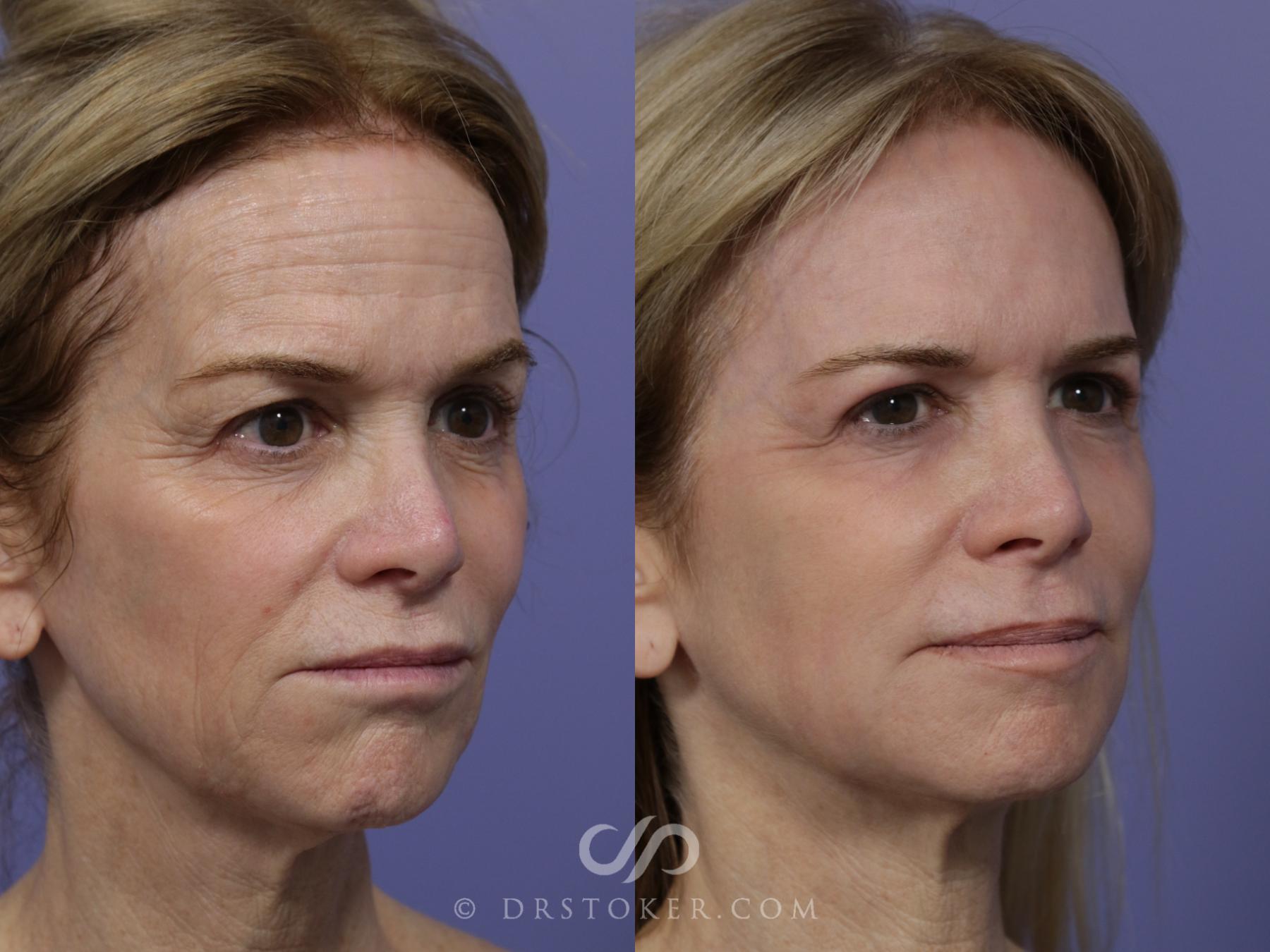 Before & After Laser Skin Resurfacing Case 897 Right Oblique View in Los Angeles, CA