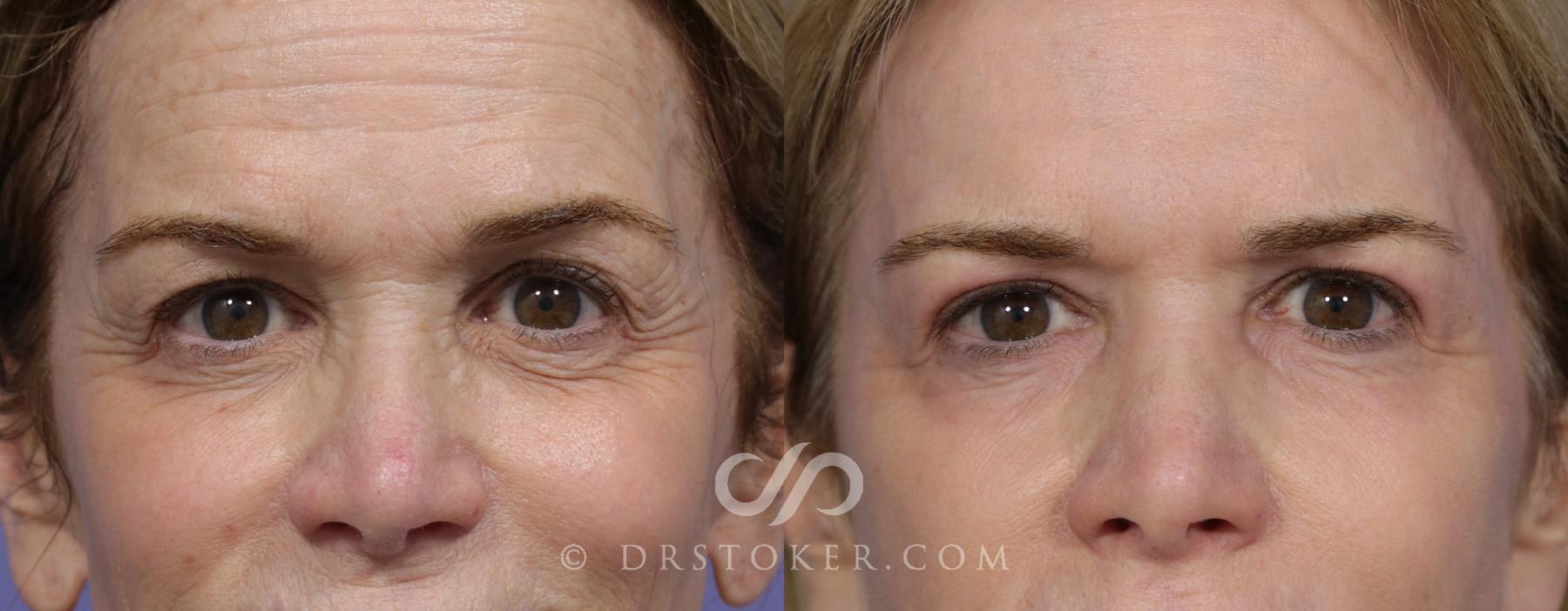 Before & After Laser Skin Resurfacing Case 897 View #1 View in Los Angeles, CA