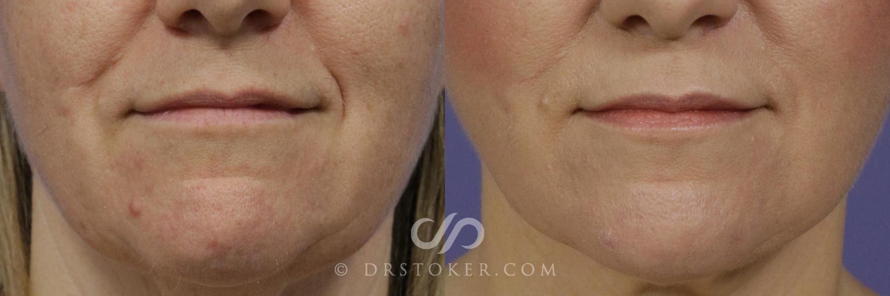 Before & After Laser Skin Resurfacing (Mouth) Case 899 View #1 View in Los Angeles, CA