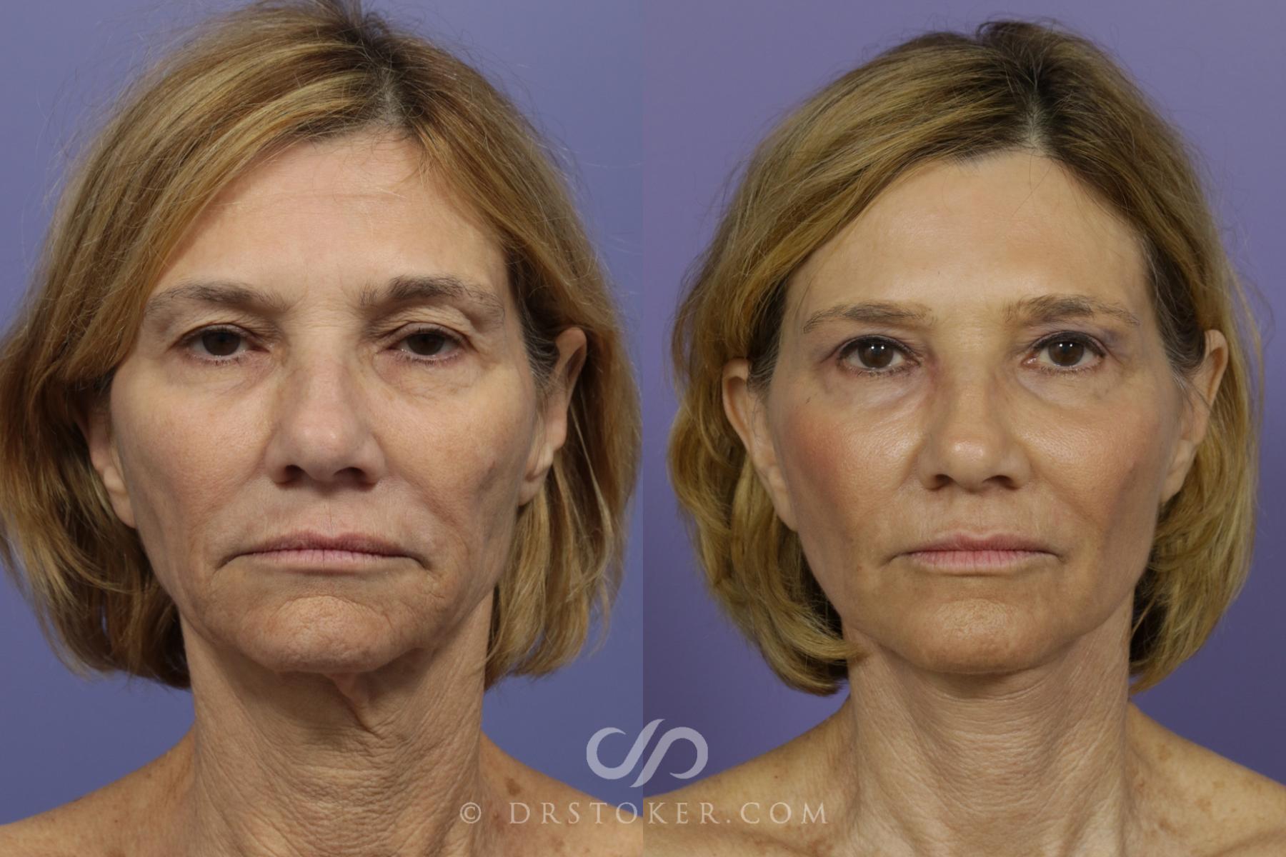 Before & After Laser Skin Resurfacing Case 901 View #1 View in Los Angeles, CA