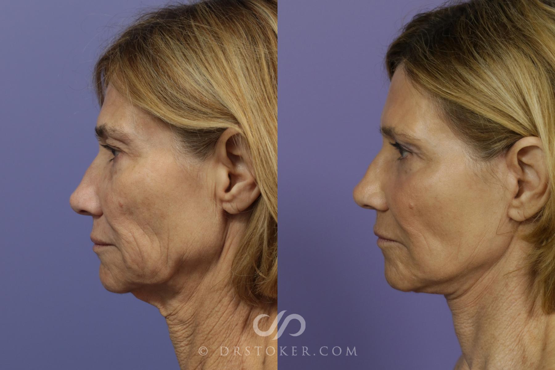 Before & After Laser Skin Resurfacing Case 901 View #5 View in Los Angeles, CA
