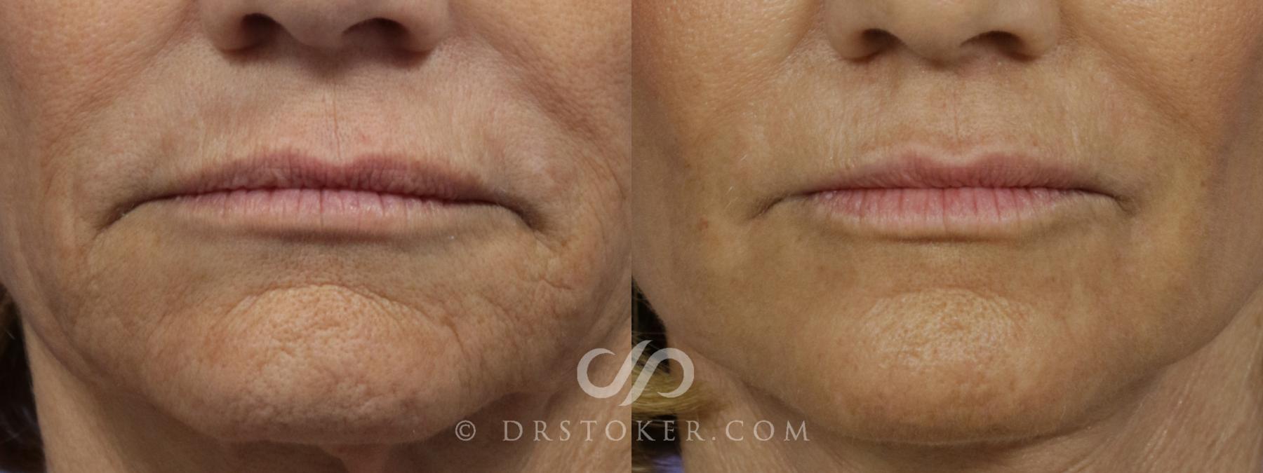 Before & After Laser Skin Resurfacing Case 901 View #6 View in Los Angeles, CA