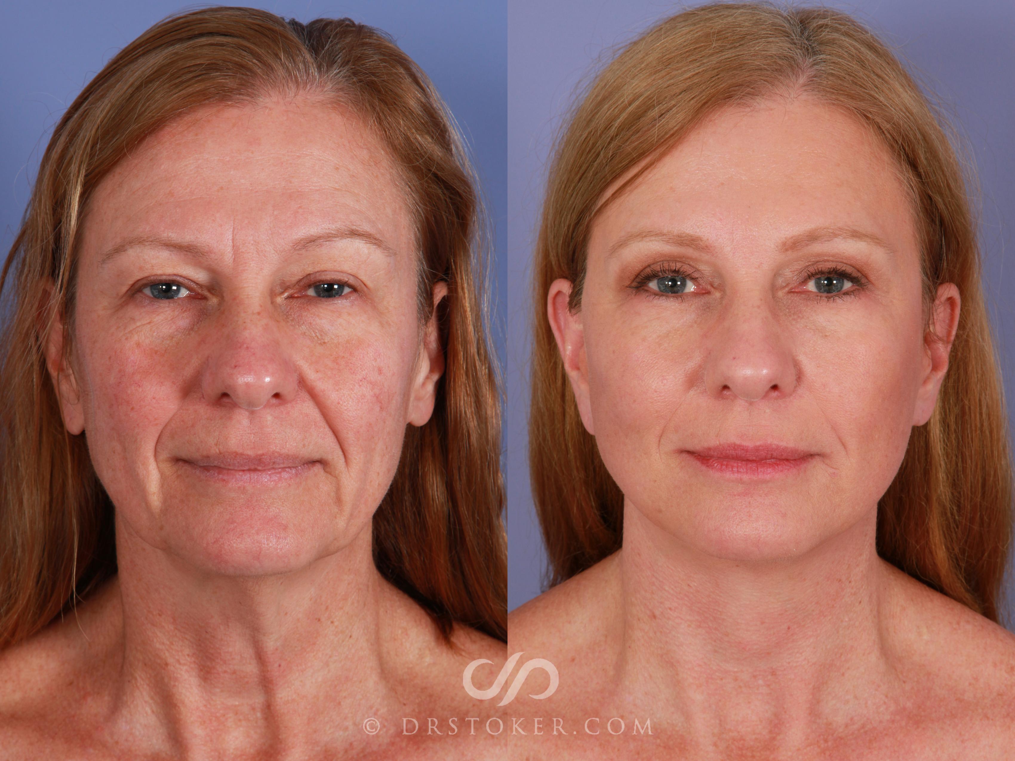 Before & After Laser Skin Resurfacing Case 902 View #1 View in Los Angeles, CA