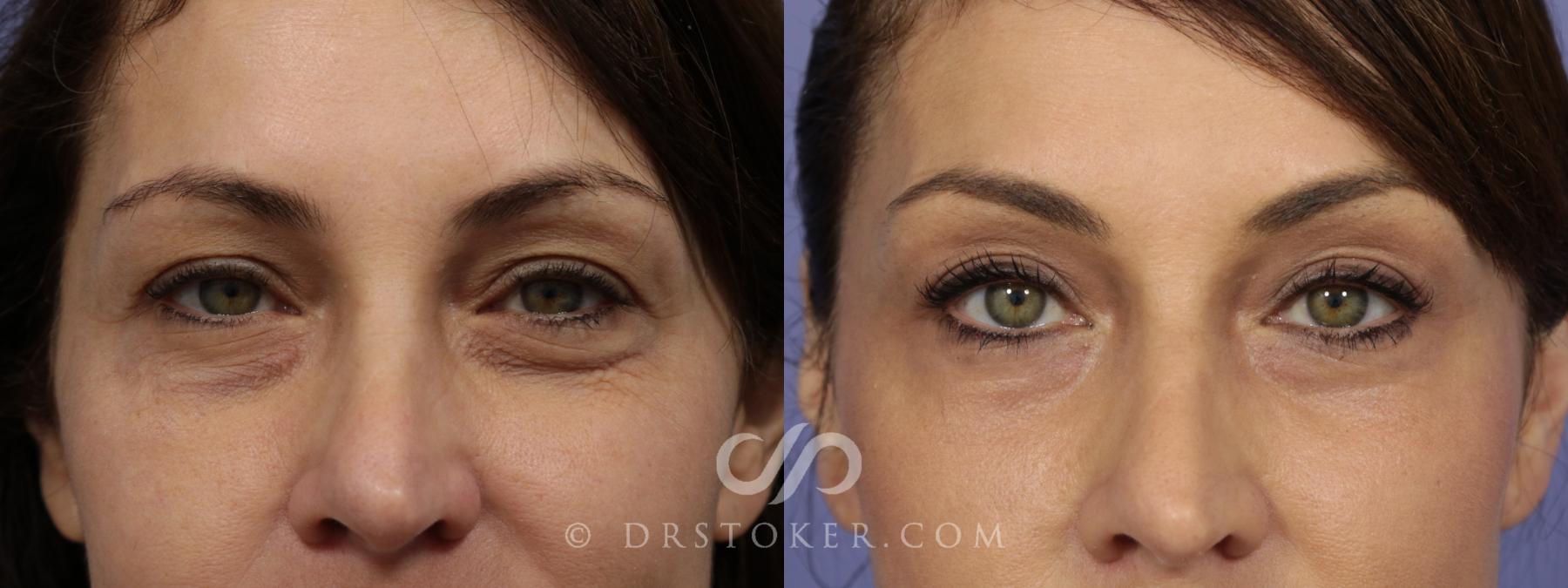 Before & After Laser Skin Resurfacing Case 909 View #1 View in Los Angeles, CA