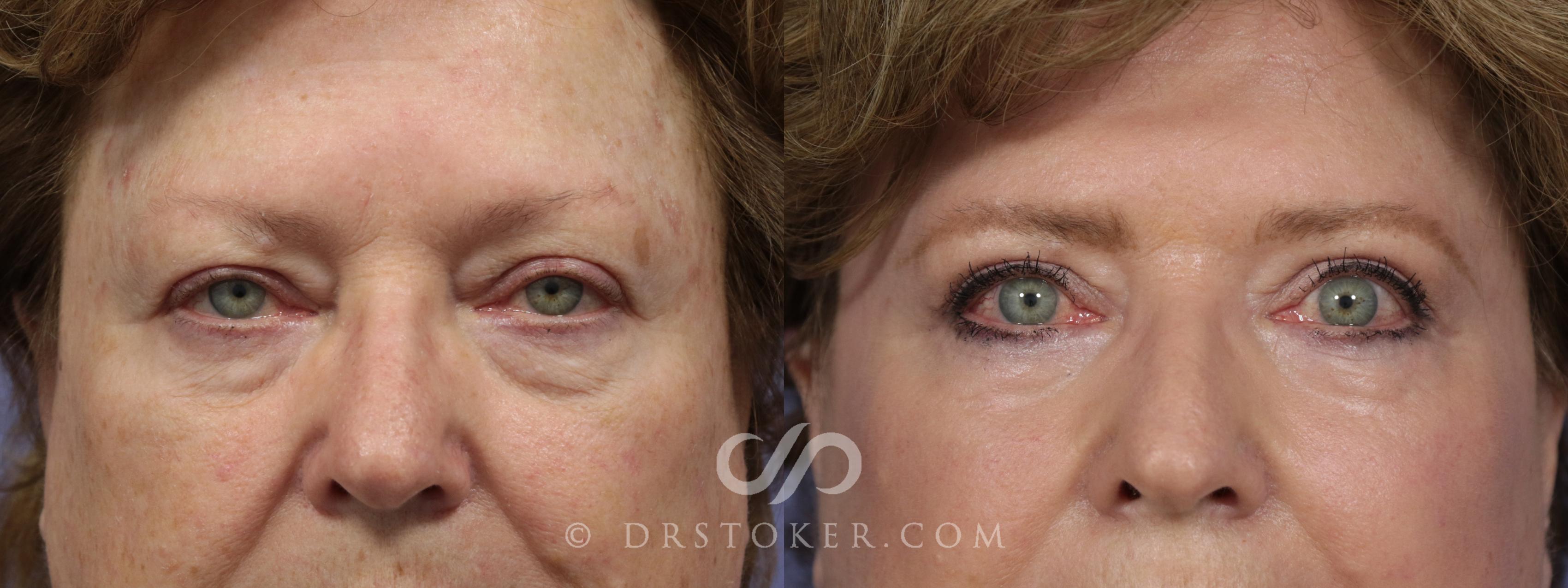 Before & After Laser Skin Resurfacing Case 910 View #1 View in Los Angeles, CA