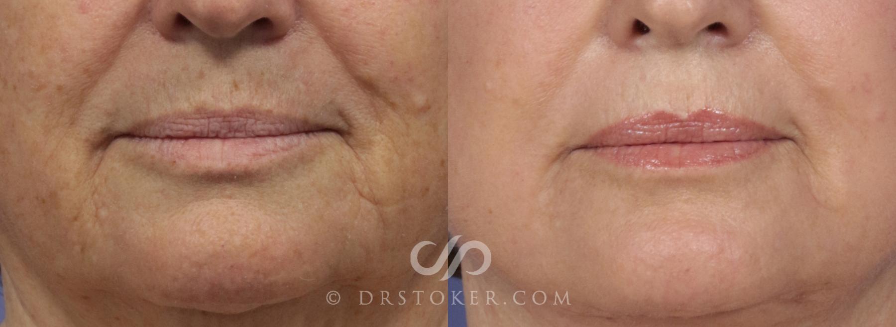 Before & After Laser Skin Resurfacing (Mouth) Case 911 View #1 View in Los Angeles, CA