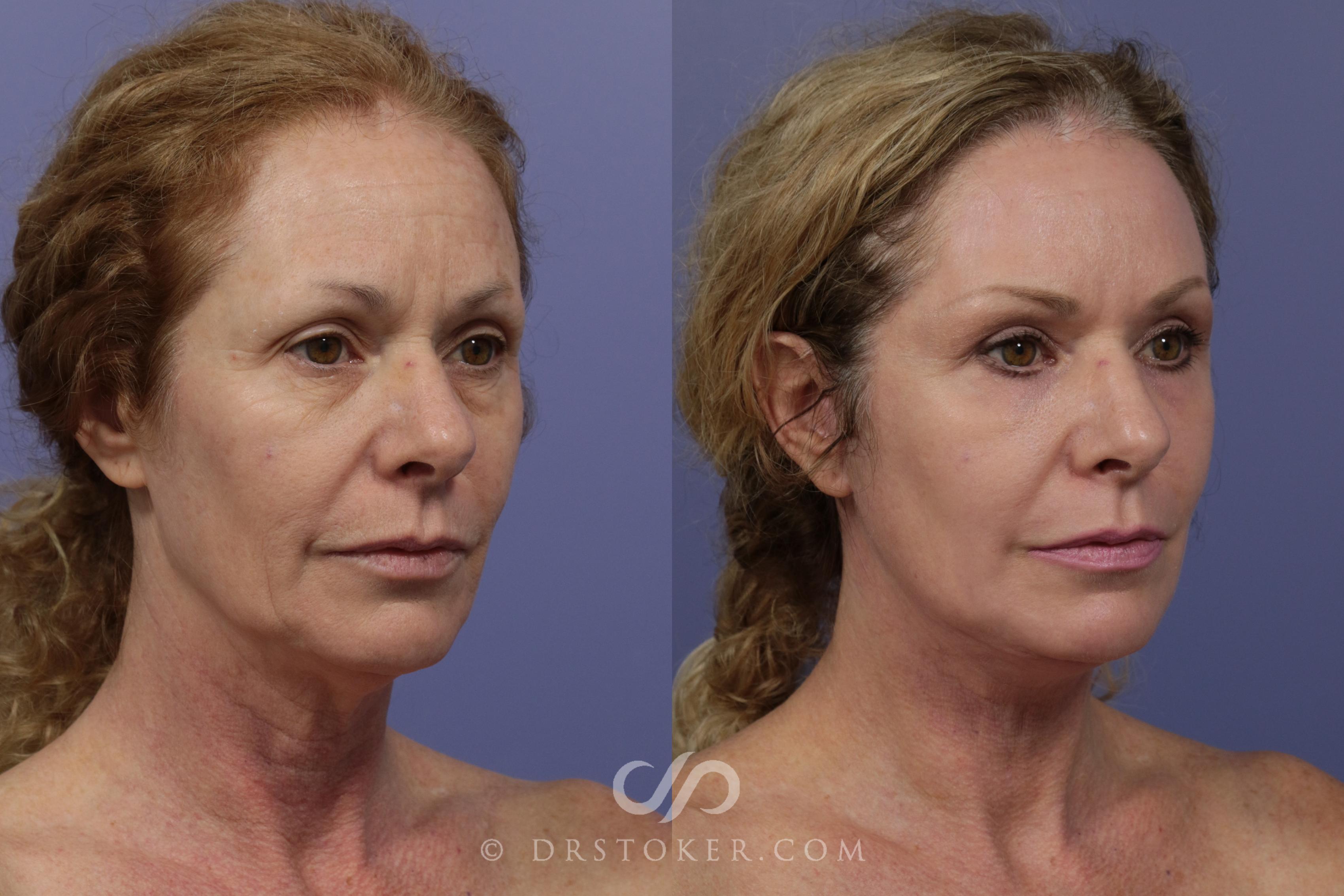 Before & After Laser Skin Resurfacing  Case 915 View #2 View in Los Angeles, CA