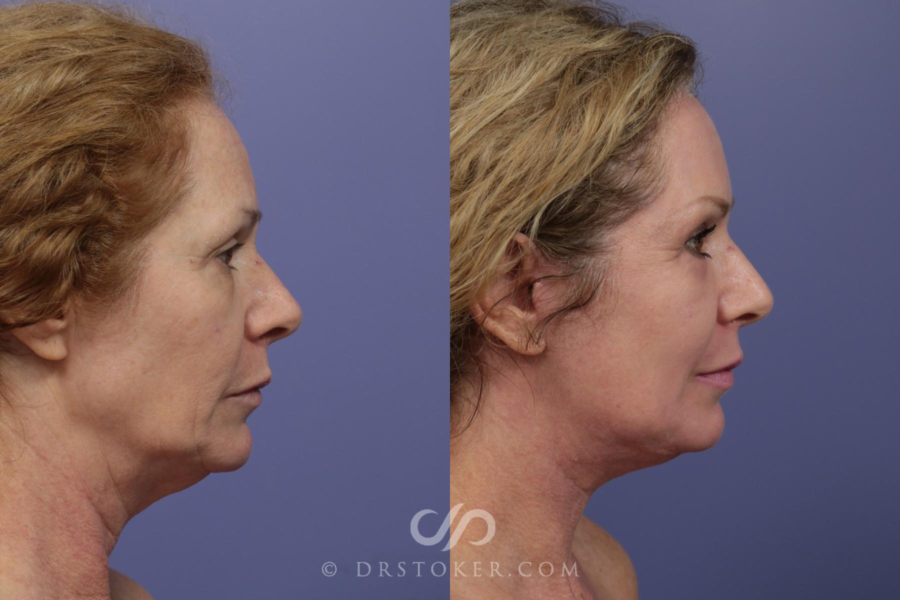 Before & After Laser Skin Resurfacing Case 915 View #3 View in Los Angeles, CA
