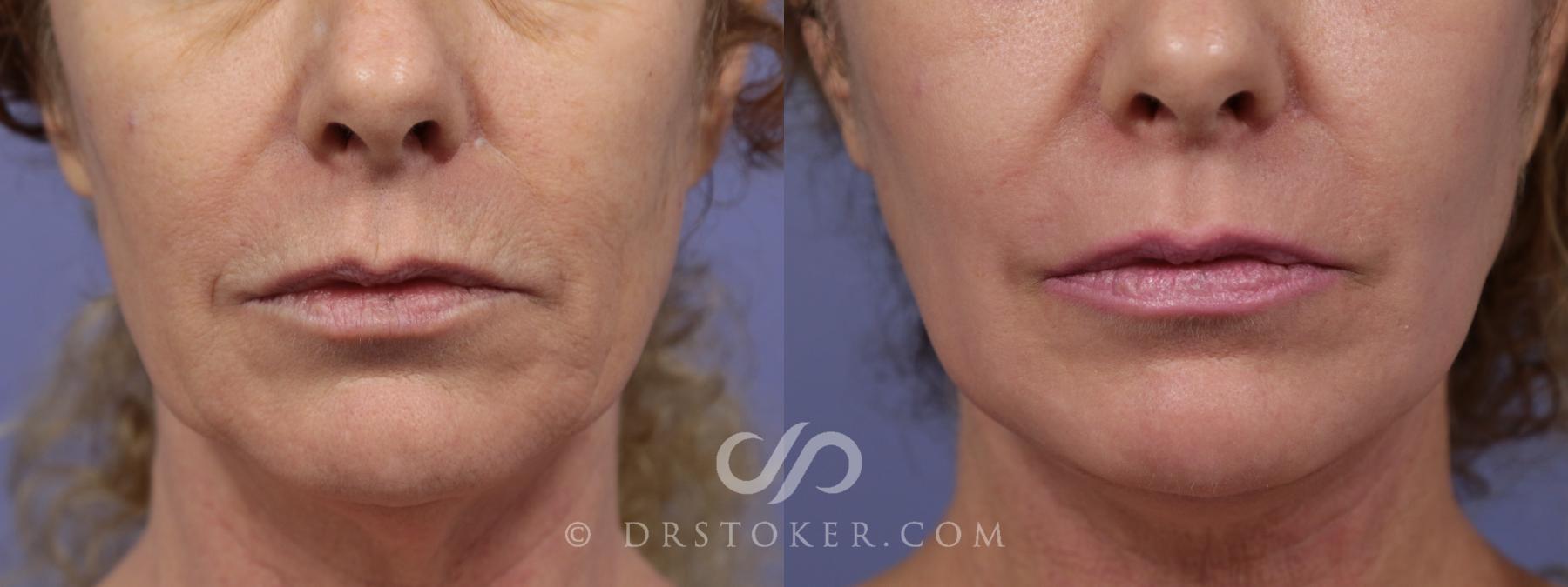Before & After Laser Skin Resurfacing Case 917 View #1 View in Los Angeles, CA