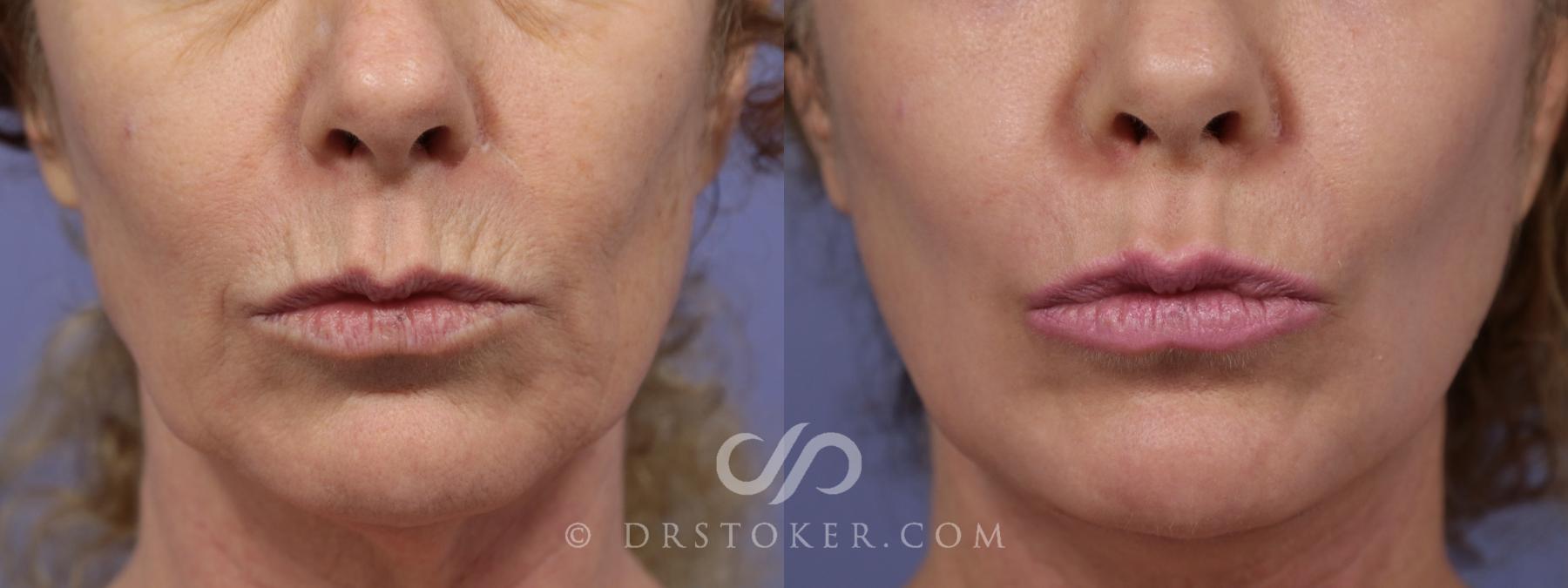 Before & After Laser Skin Resurfacing (Mouth) Case 917 View #2 View in Los Angeles, CA