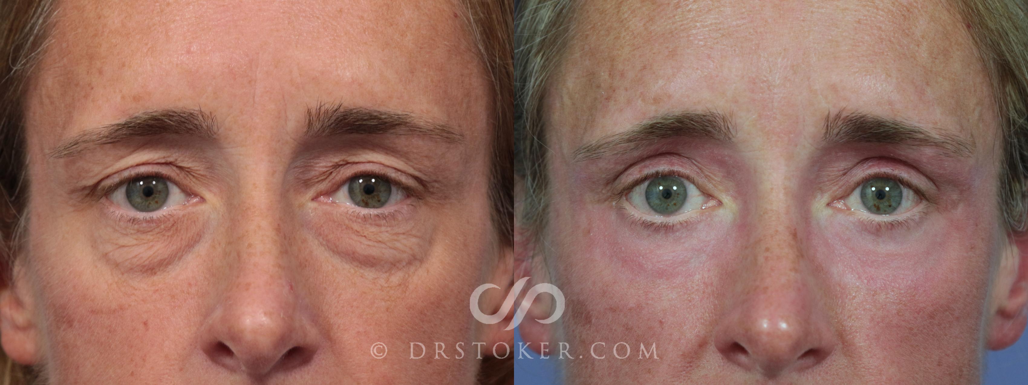 Before & After Laser Skin Resurfacing Case 918 View #1 View in Los Angeles, CA