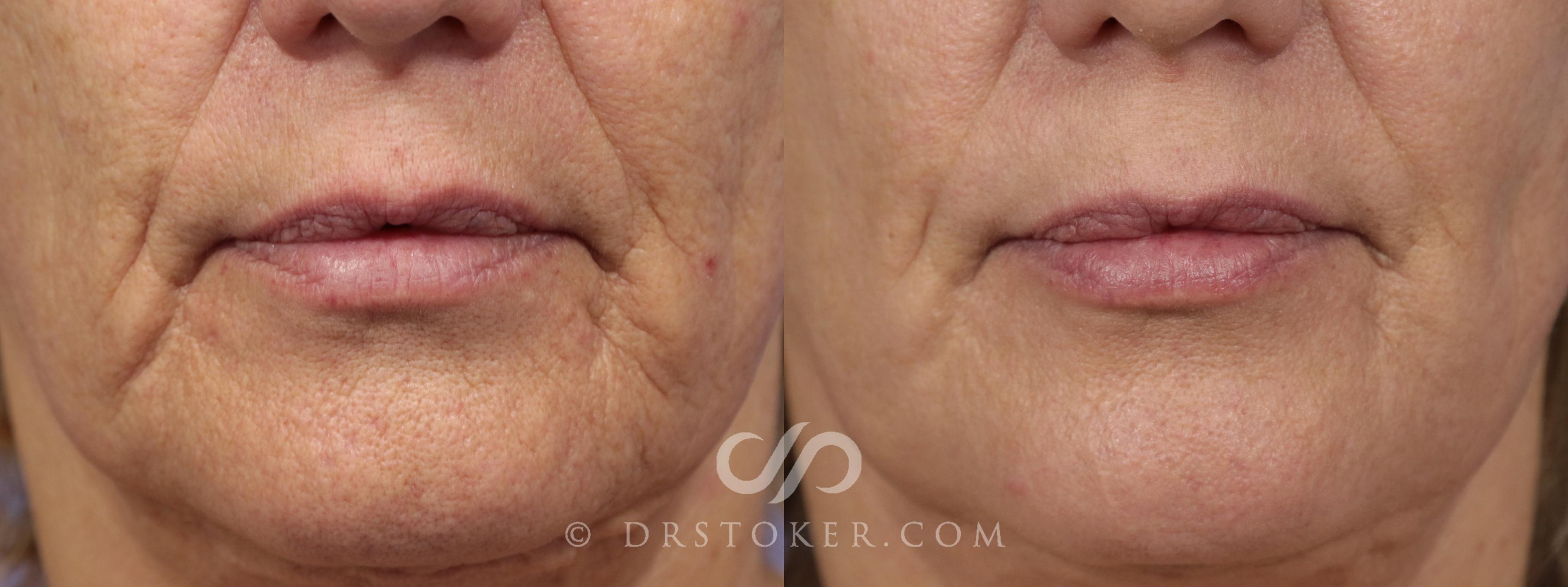 Before & After Laser Resurfacing Mouth Case 921 View #1 View in Marina del Rey, CA