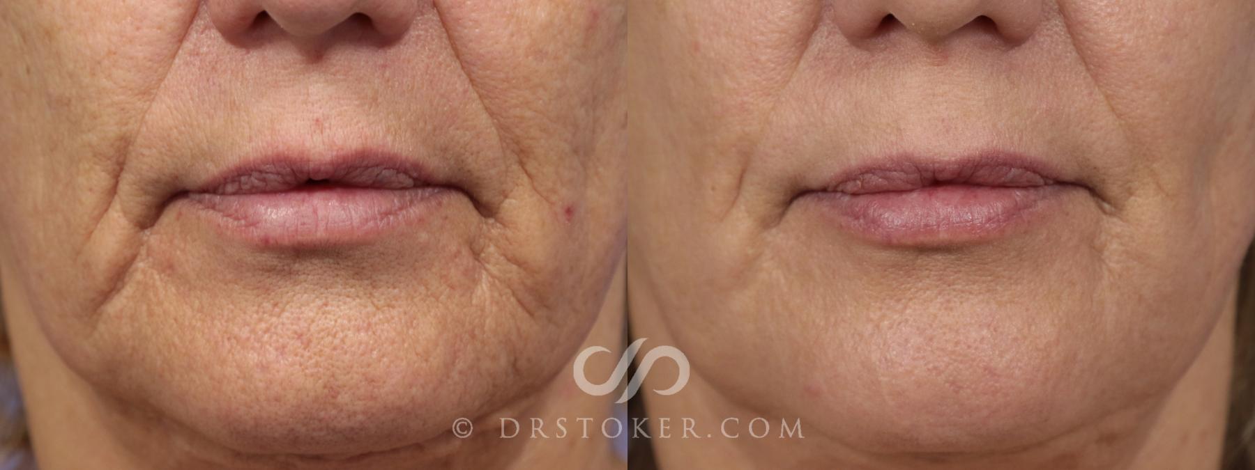 Before & After Laser Skin Resurfacing (Mouth) Case 921 View #1 View in Los Angeles, CA