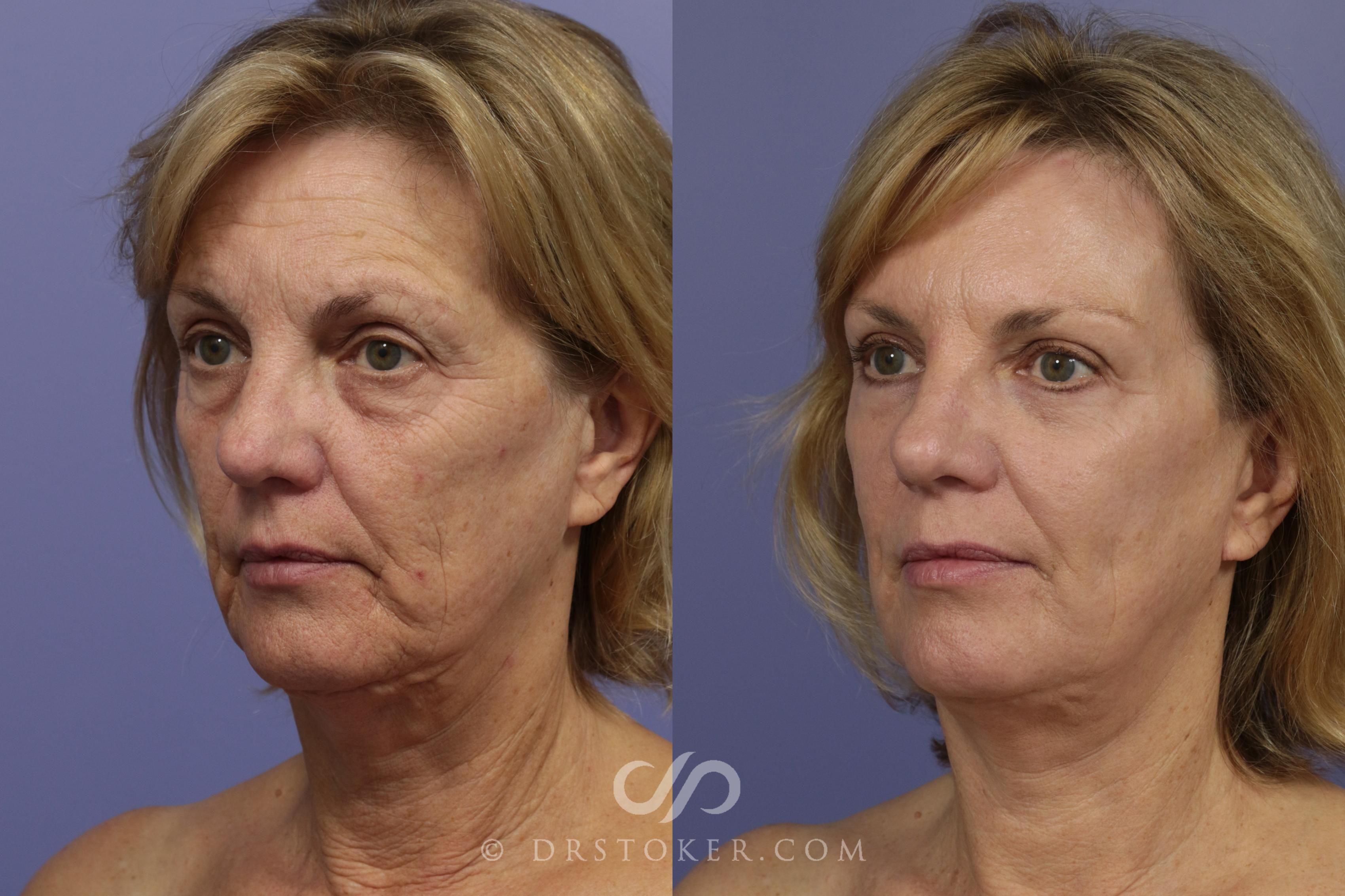 Before & After Laser Skin Resurfacing  Case 922 View #2 View in Los Angeles, CA