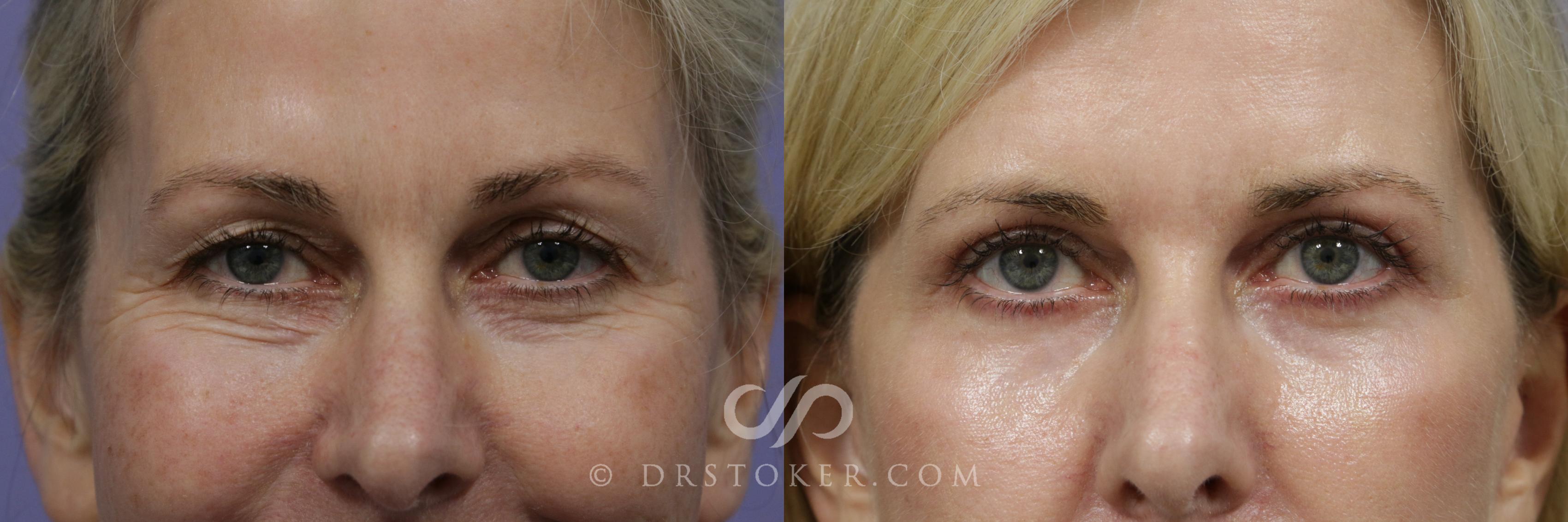 Before & After Laser Resurfacing  Case 924 View #1 View in Marina del Rey, CA