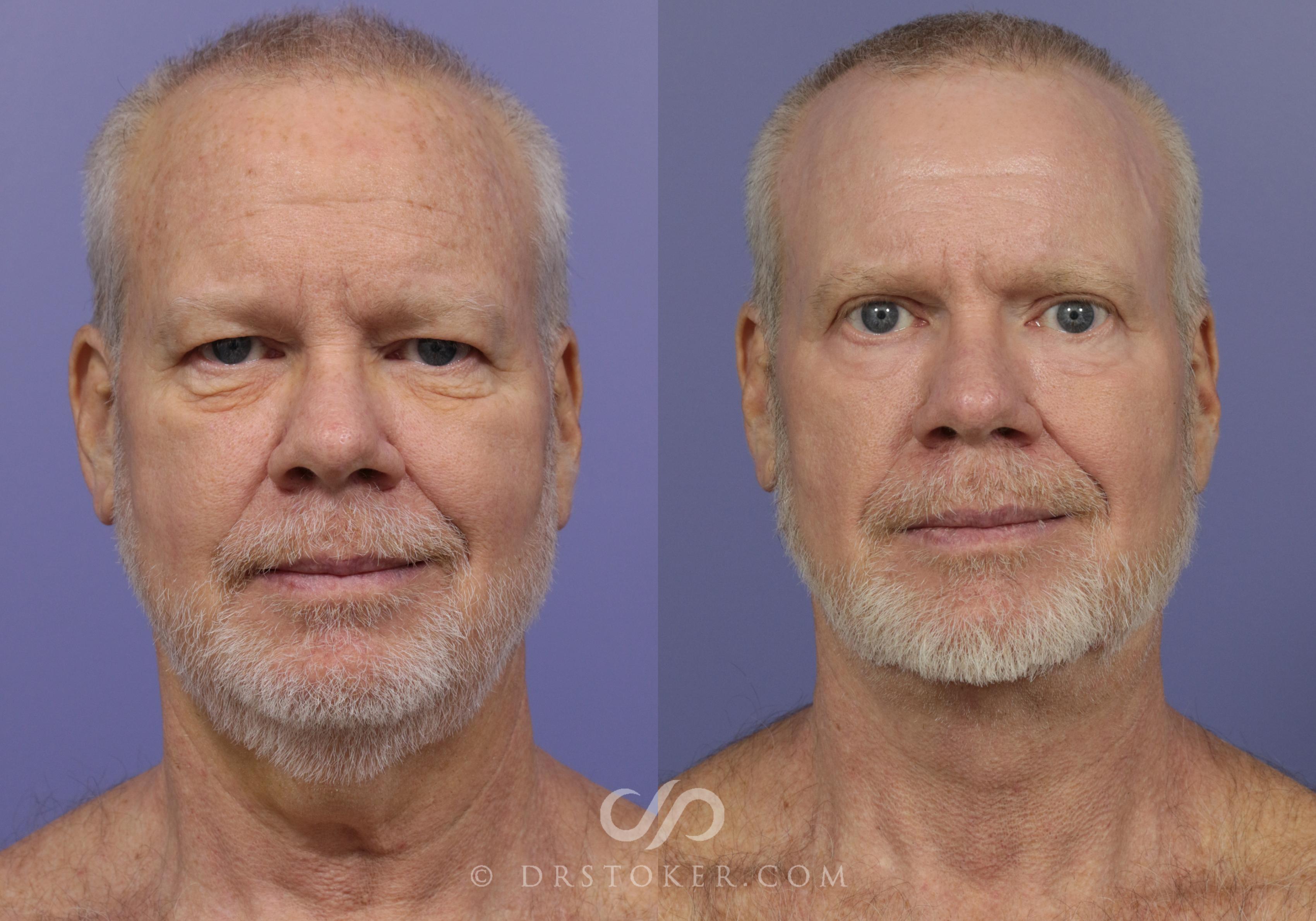 Before & After Laser Skin Resurfacing Case 926 View #1 View in Los Angeles, CA