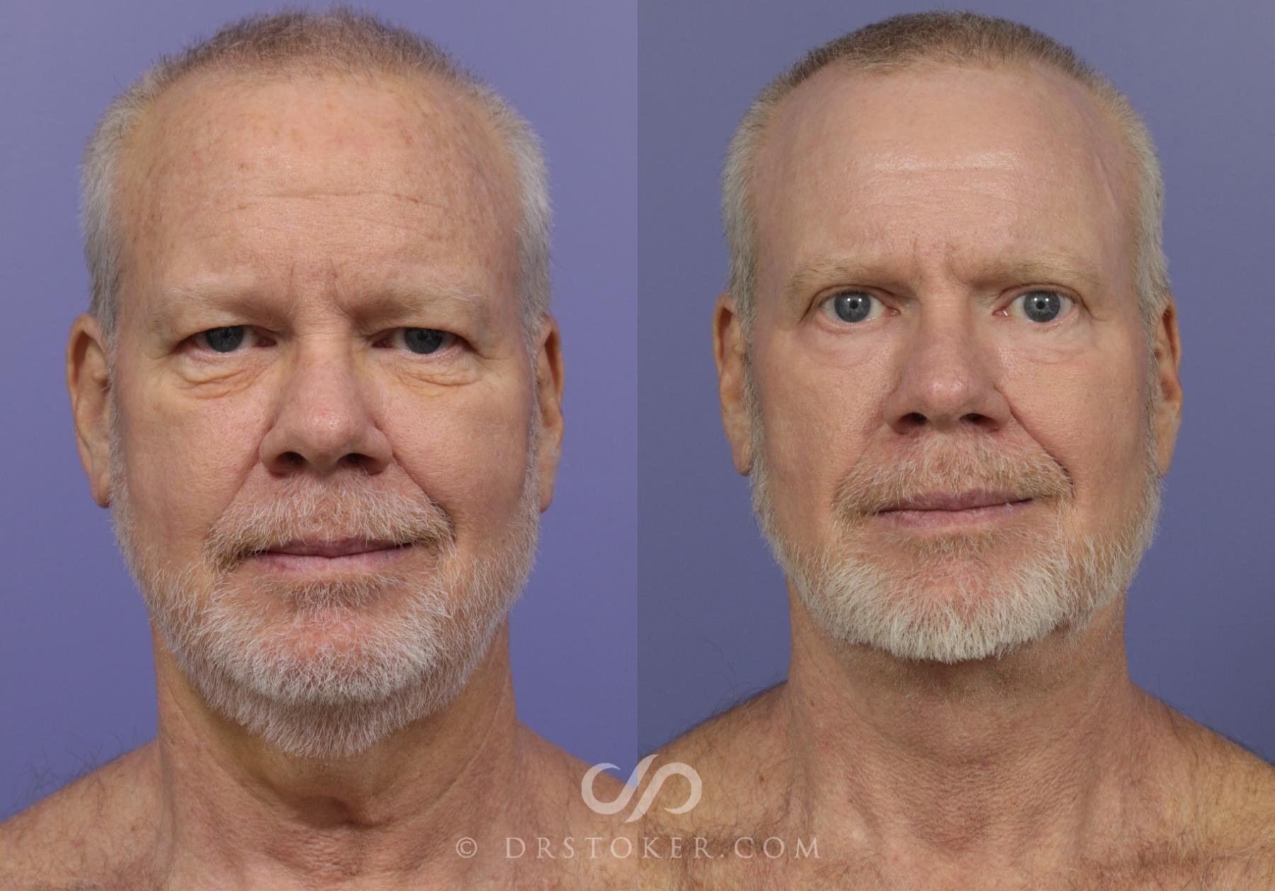 Before & After Laser Skin Resurfacing Case 926 View #1 View in Los Angeles, CA