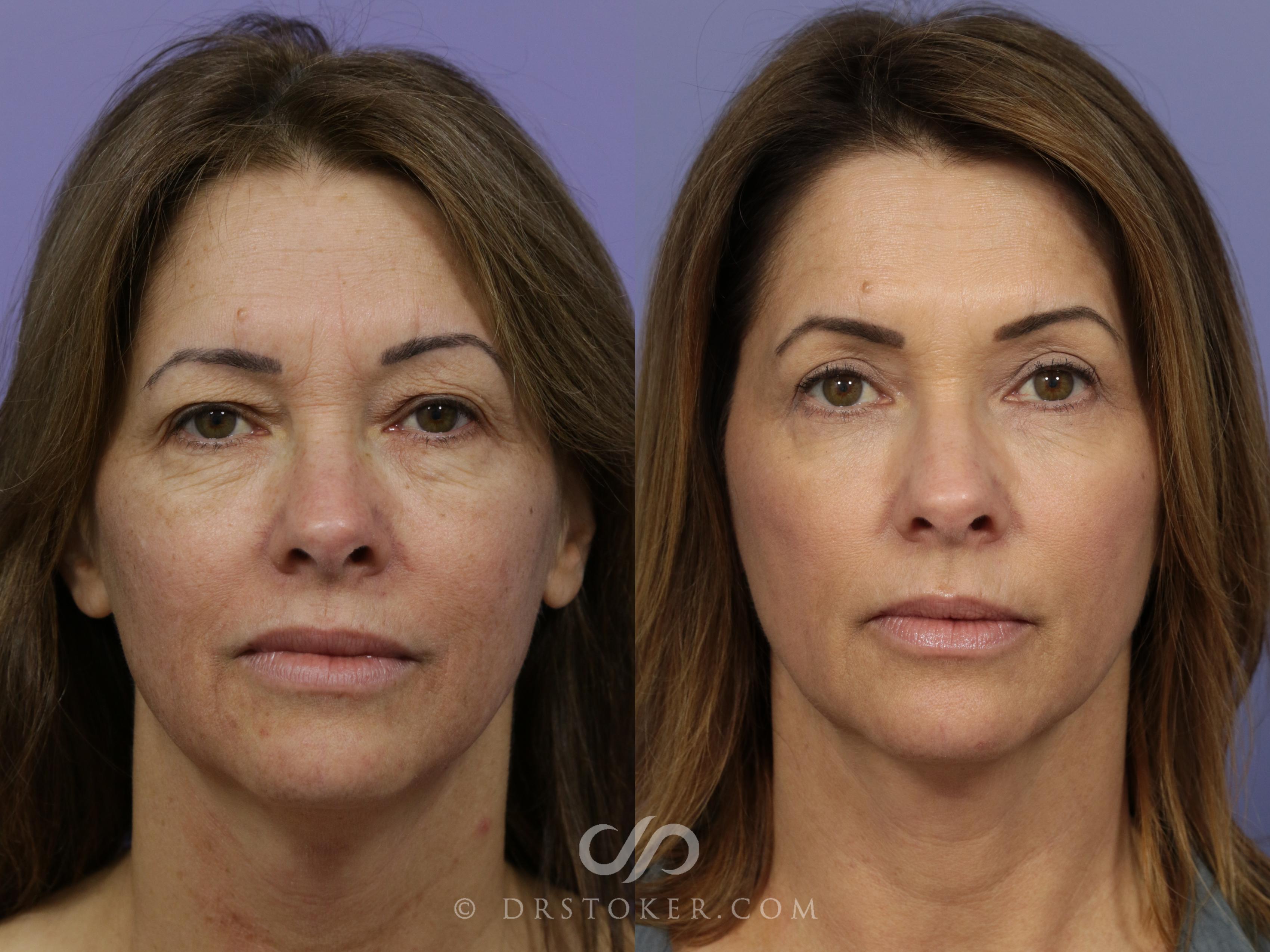 Before & After Laser Skin Resurfacing Case 928 View #1 View in Marina del Rey, CA