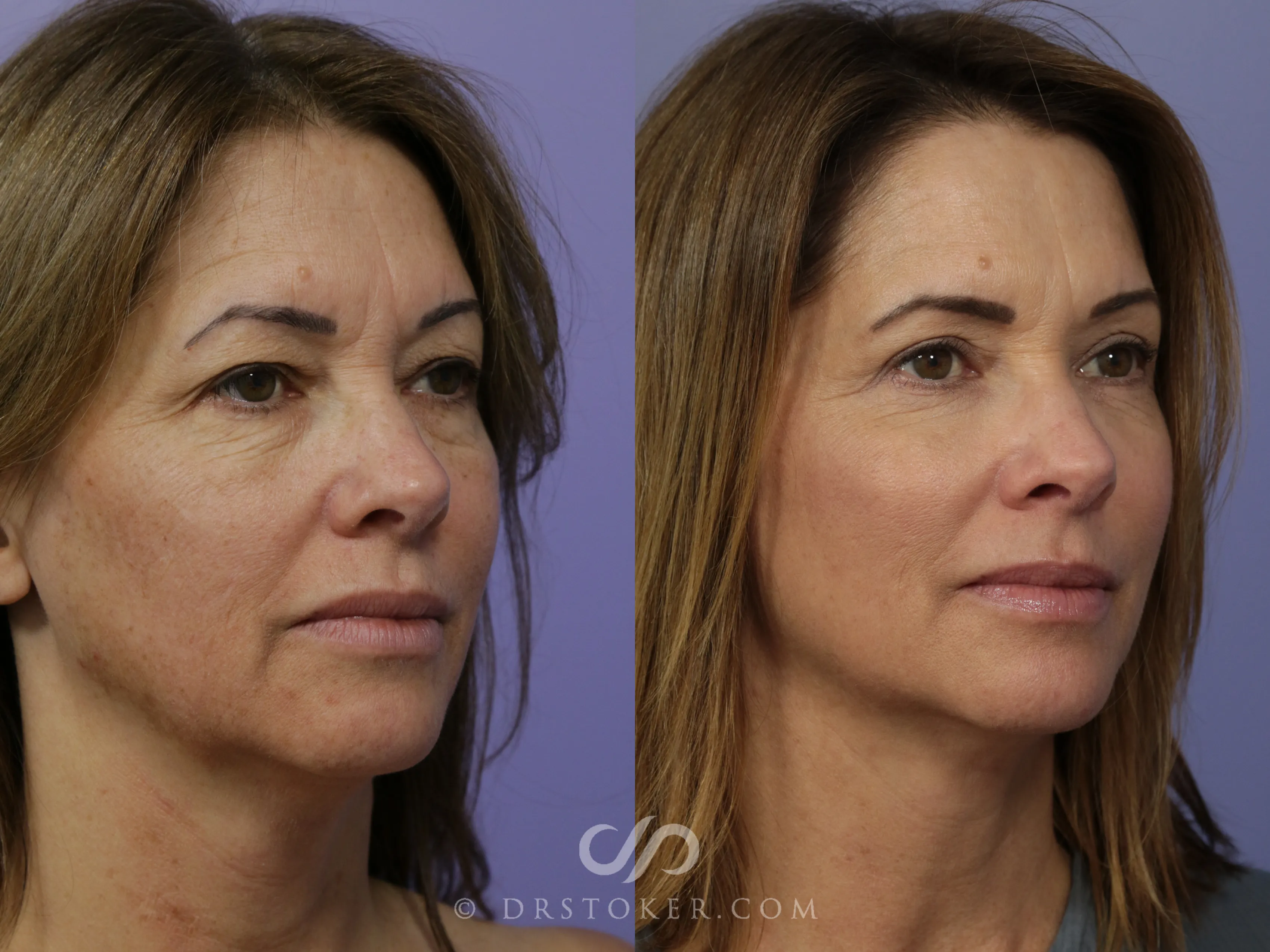Laser Skin Resurfacing Before and After Pictures Case 928 | Los